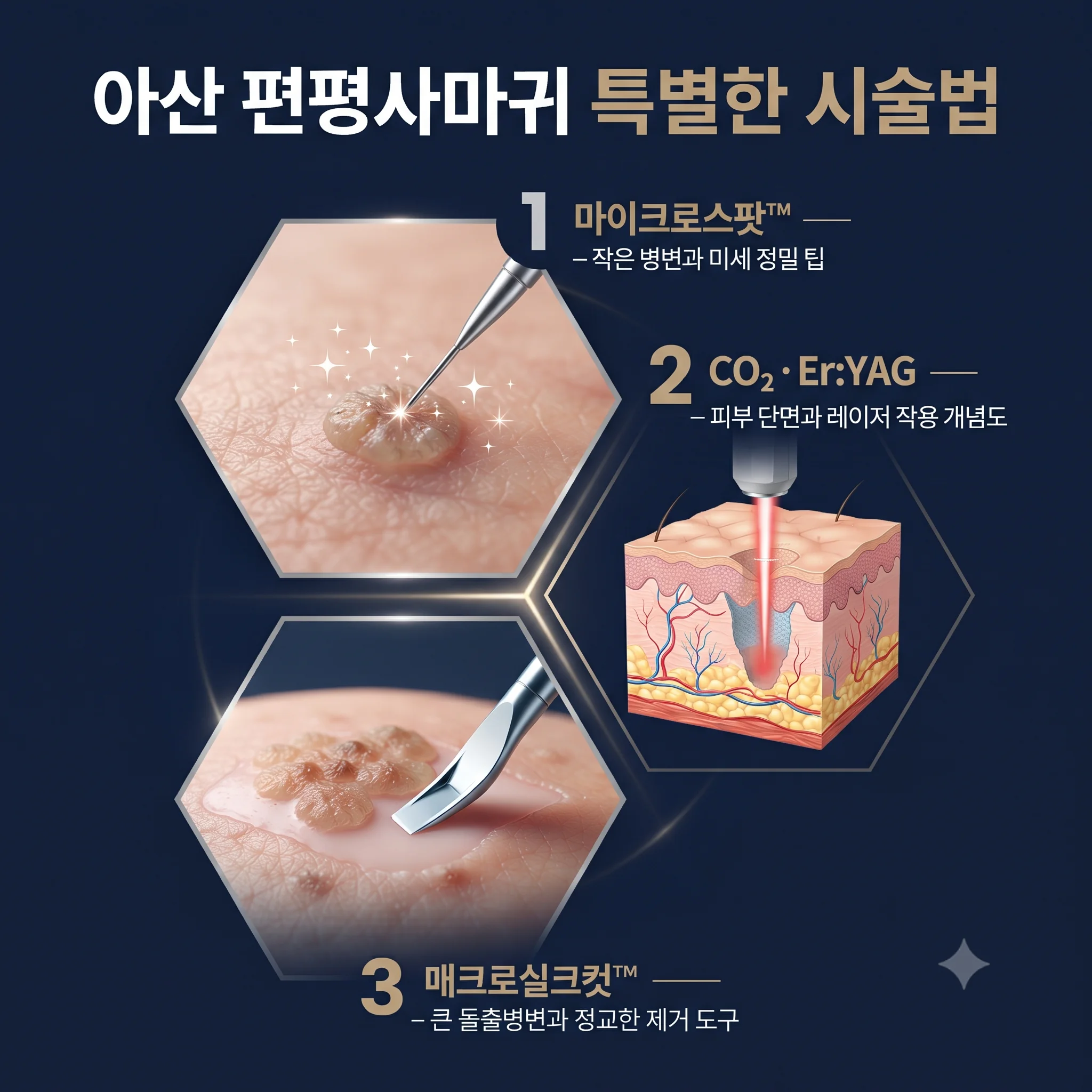 아산 편평사마귀 특별한 시술법