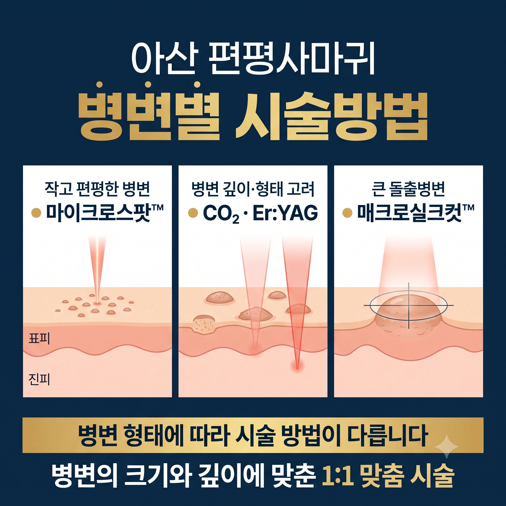 아산 편평사마귀 특별한 시술법