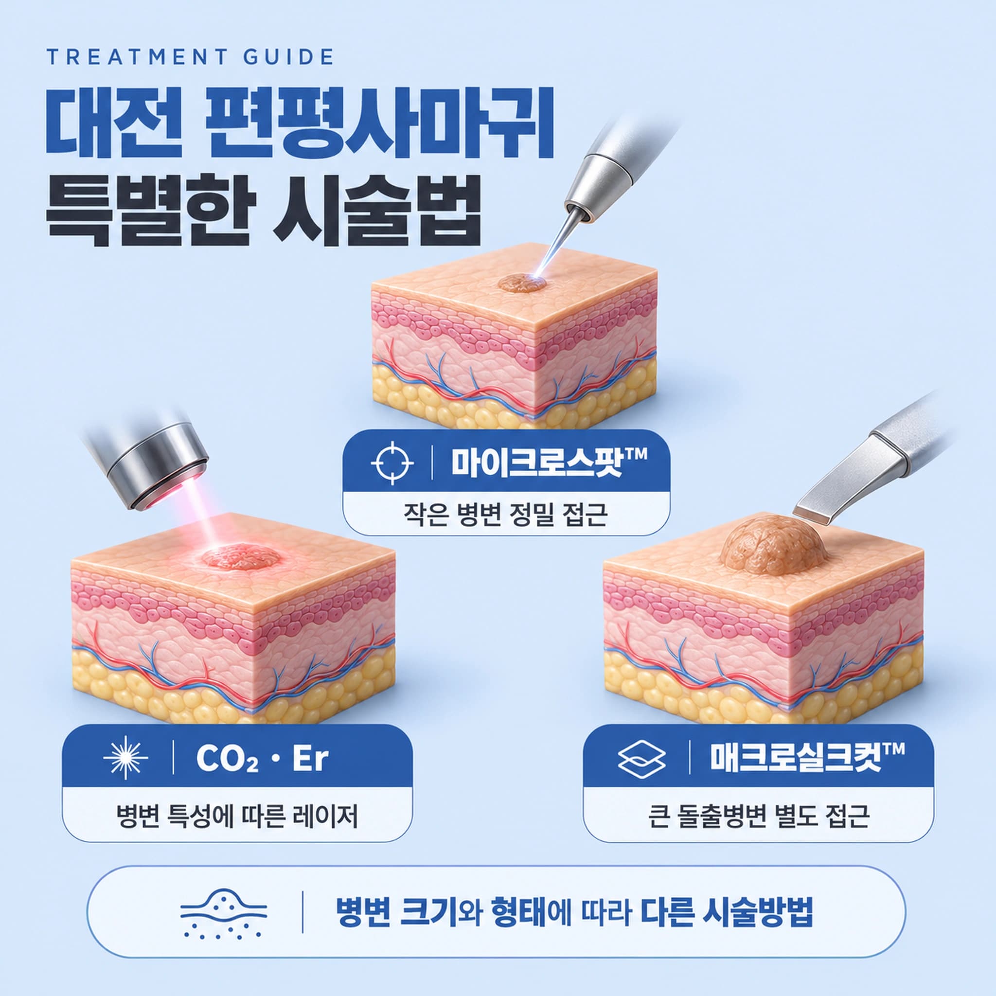 대전 편평사마귀 특별한 시술법