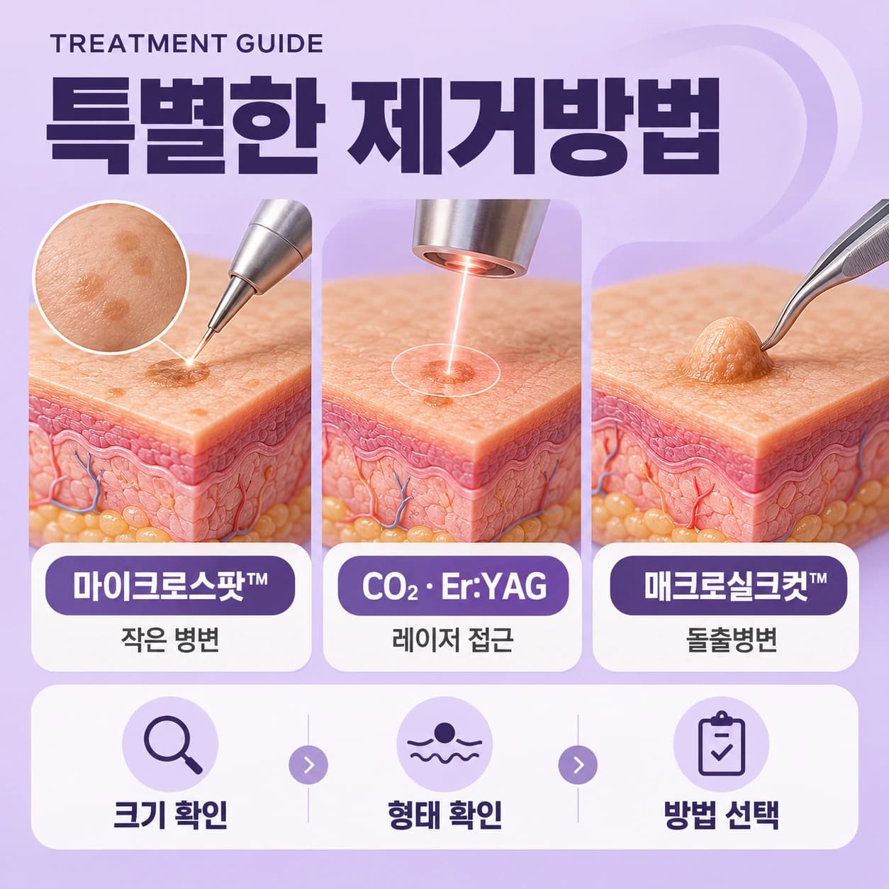 천안 편평사마귀 특별한 시술법