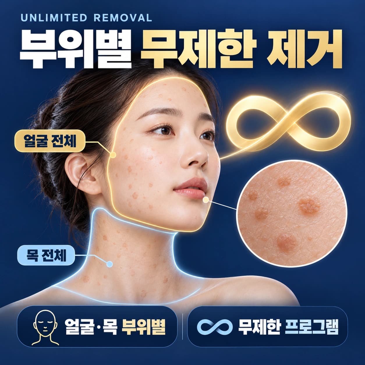 천안 편평사마귀 무제한