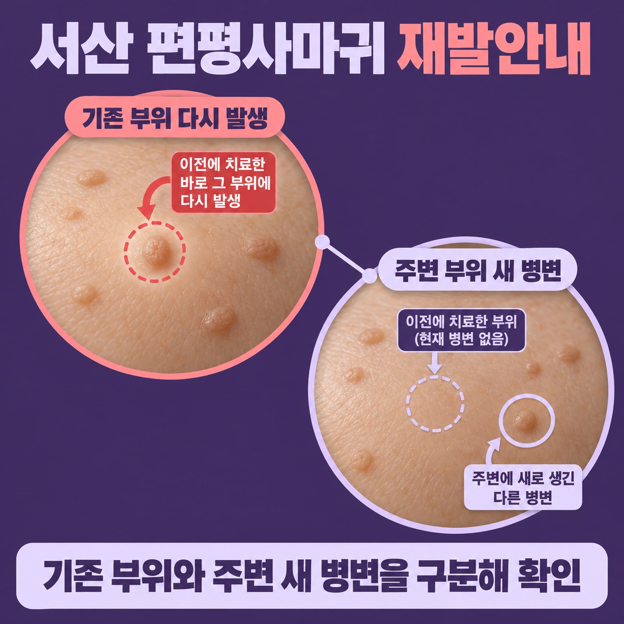 서산 편평사마귀 재발안내