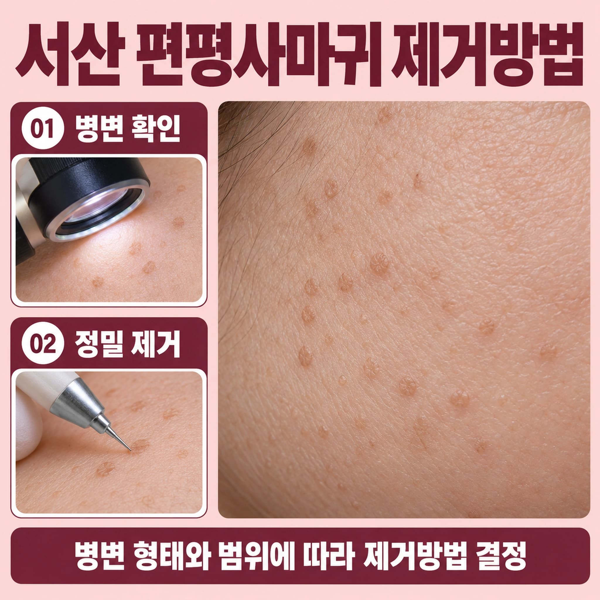 서산 편평사마귀 제거방법