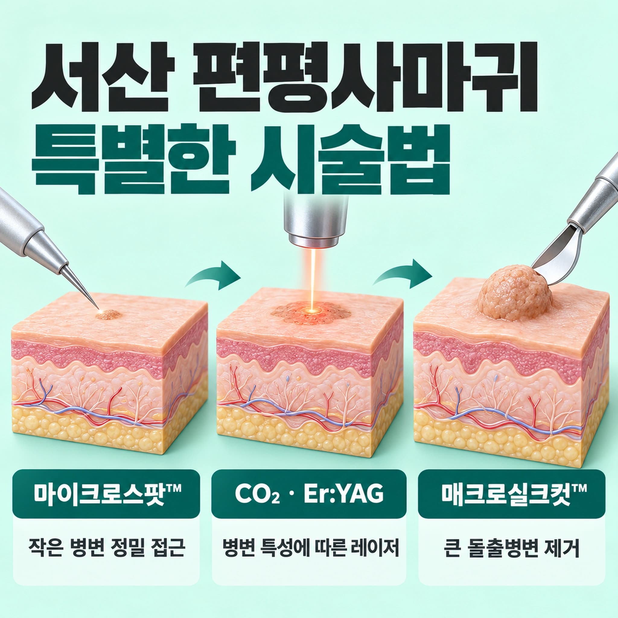 서산 편평사마귀 특별한 시술법