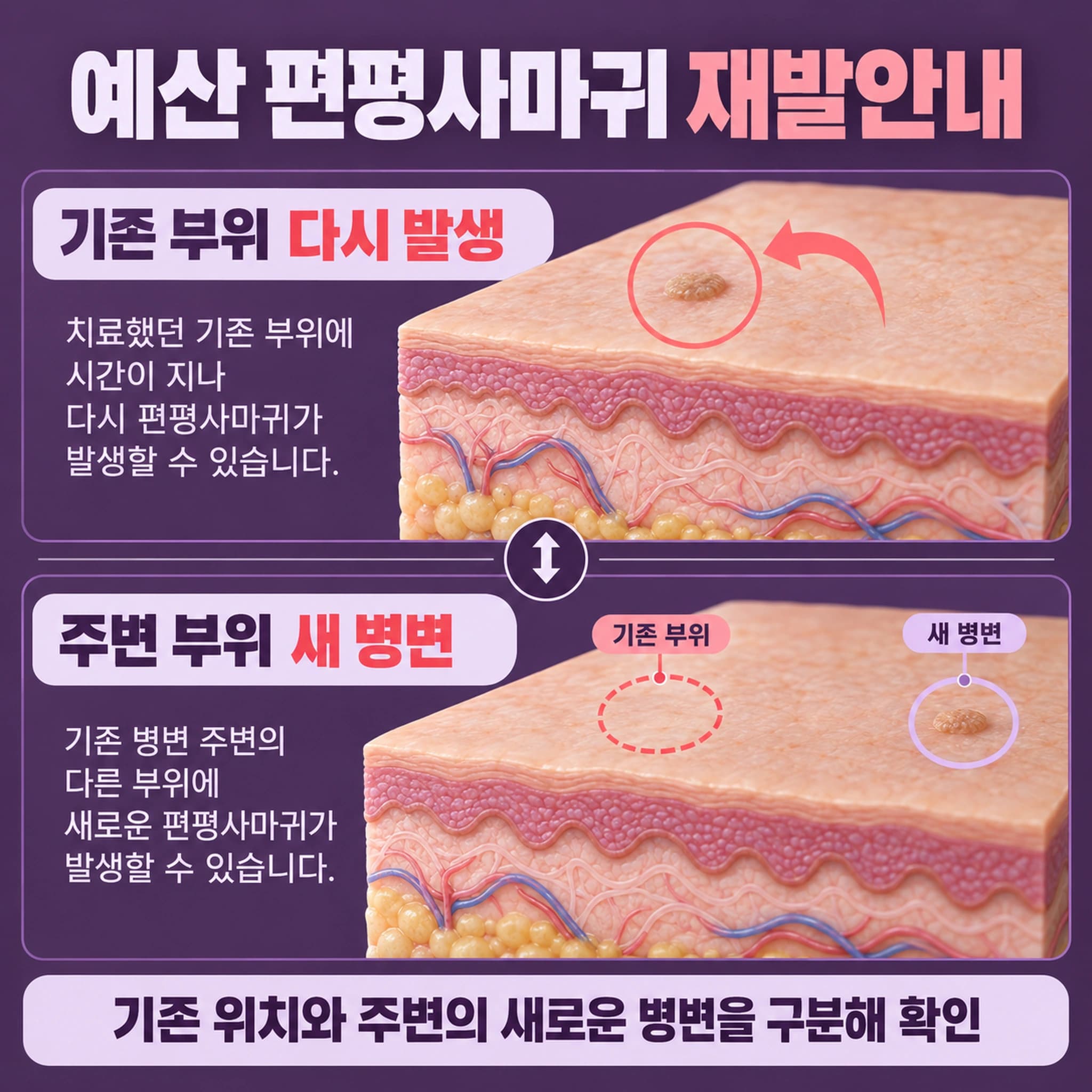 예산 편평사마귀 재발안내