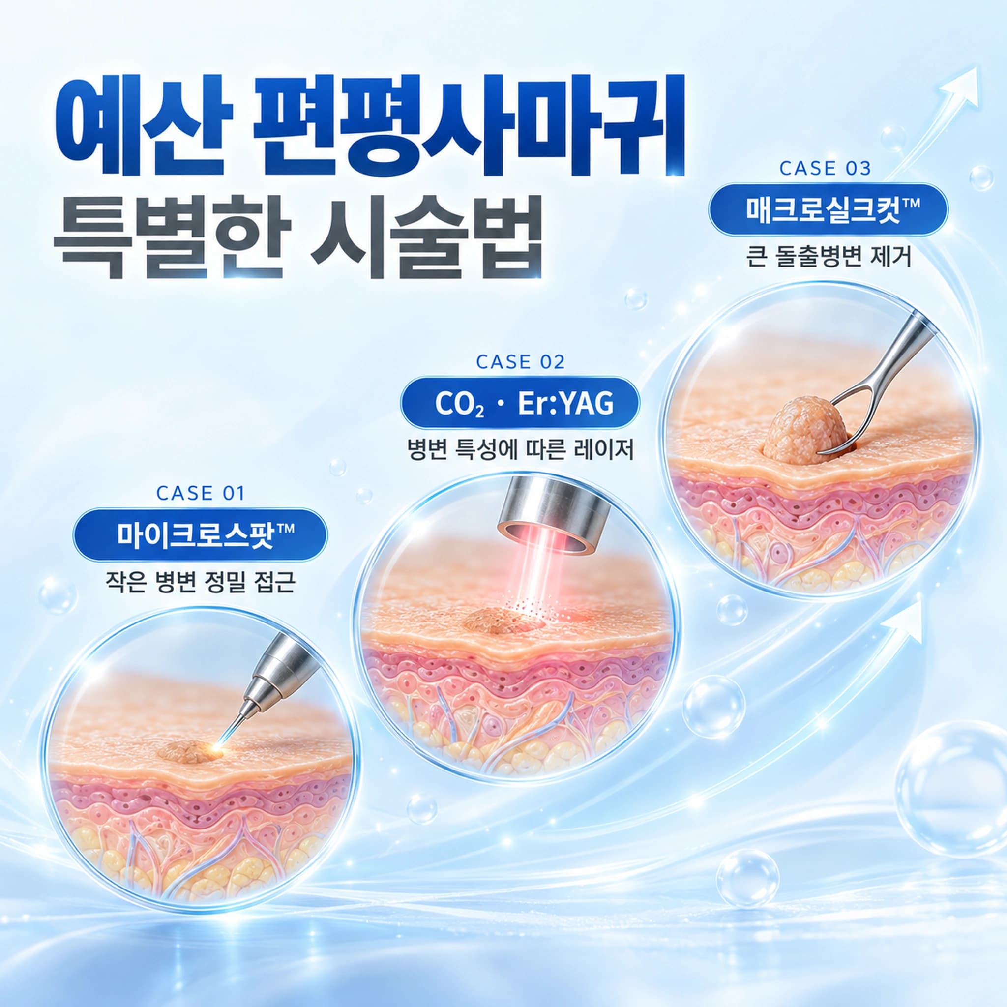 예산 편평사마귀 특별한 시술법