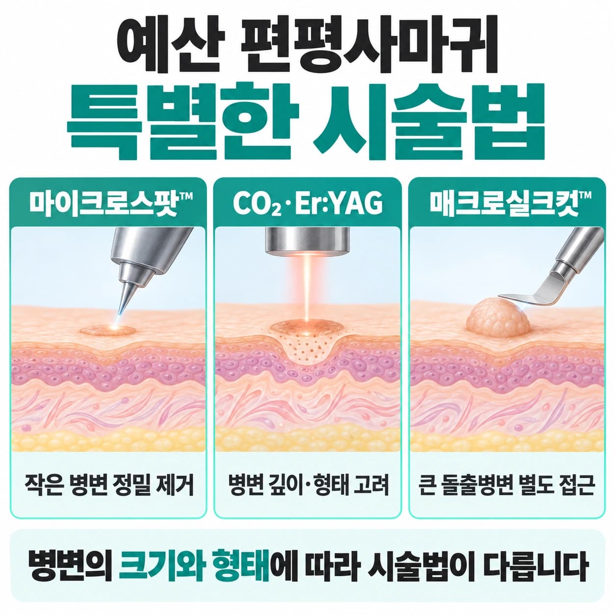 예산 편평사마귀 특별한 시술법