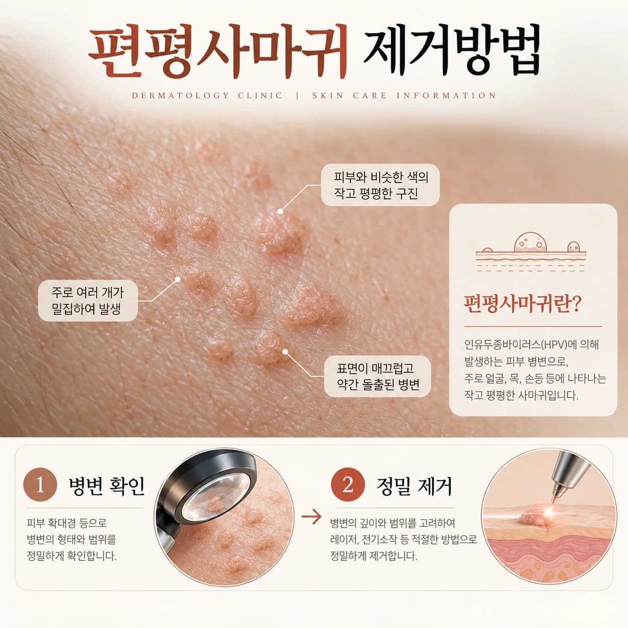 천안 편평사마귀 제거방법