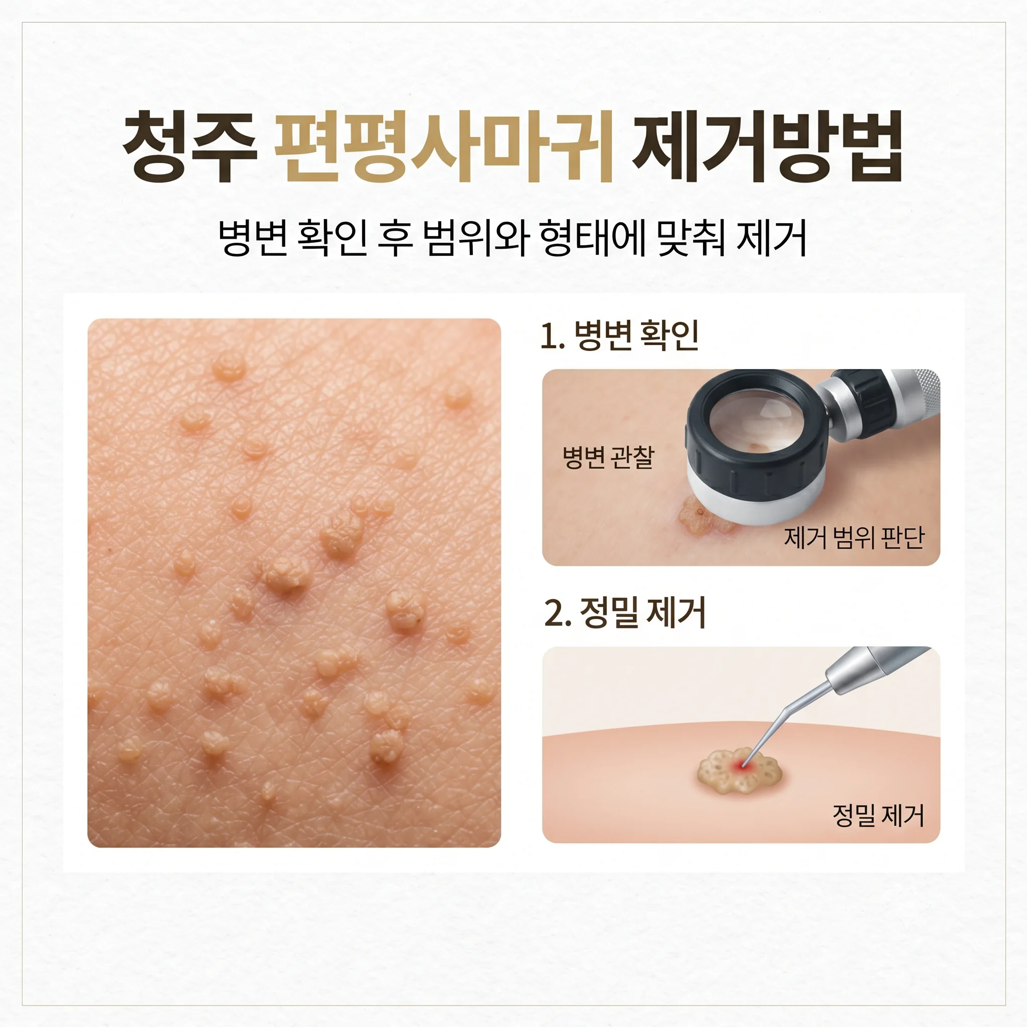 청주 편평사마귀 제거방법
