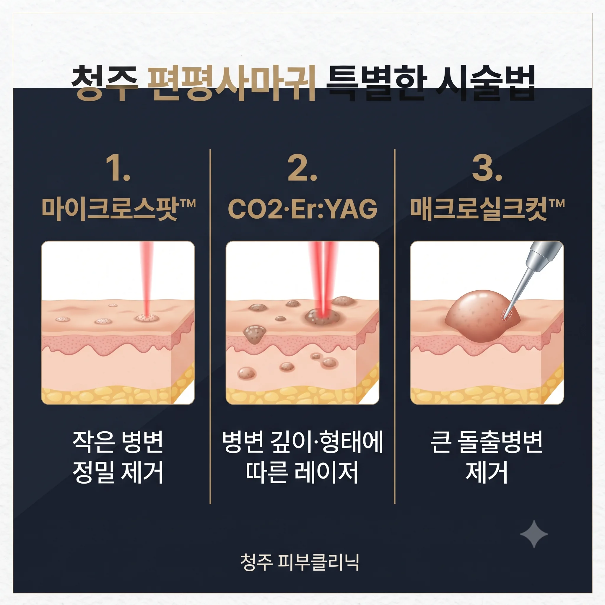청주 편평사마귀 특별한 시술법