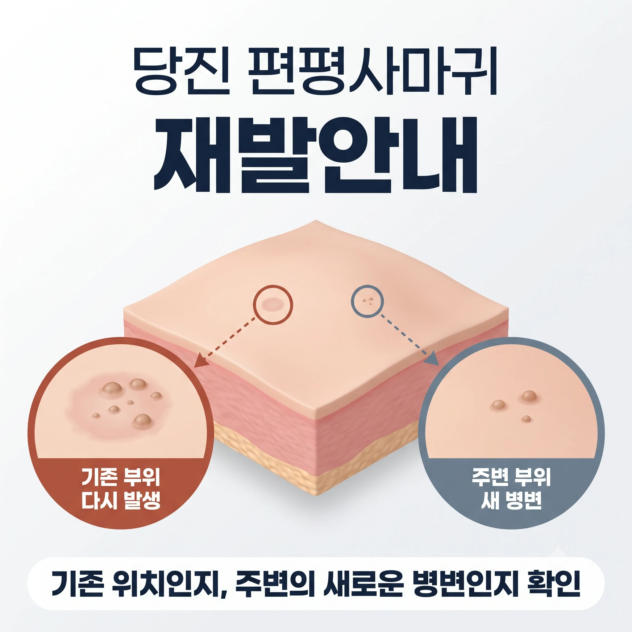 당진 편평사마귀 재발안내