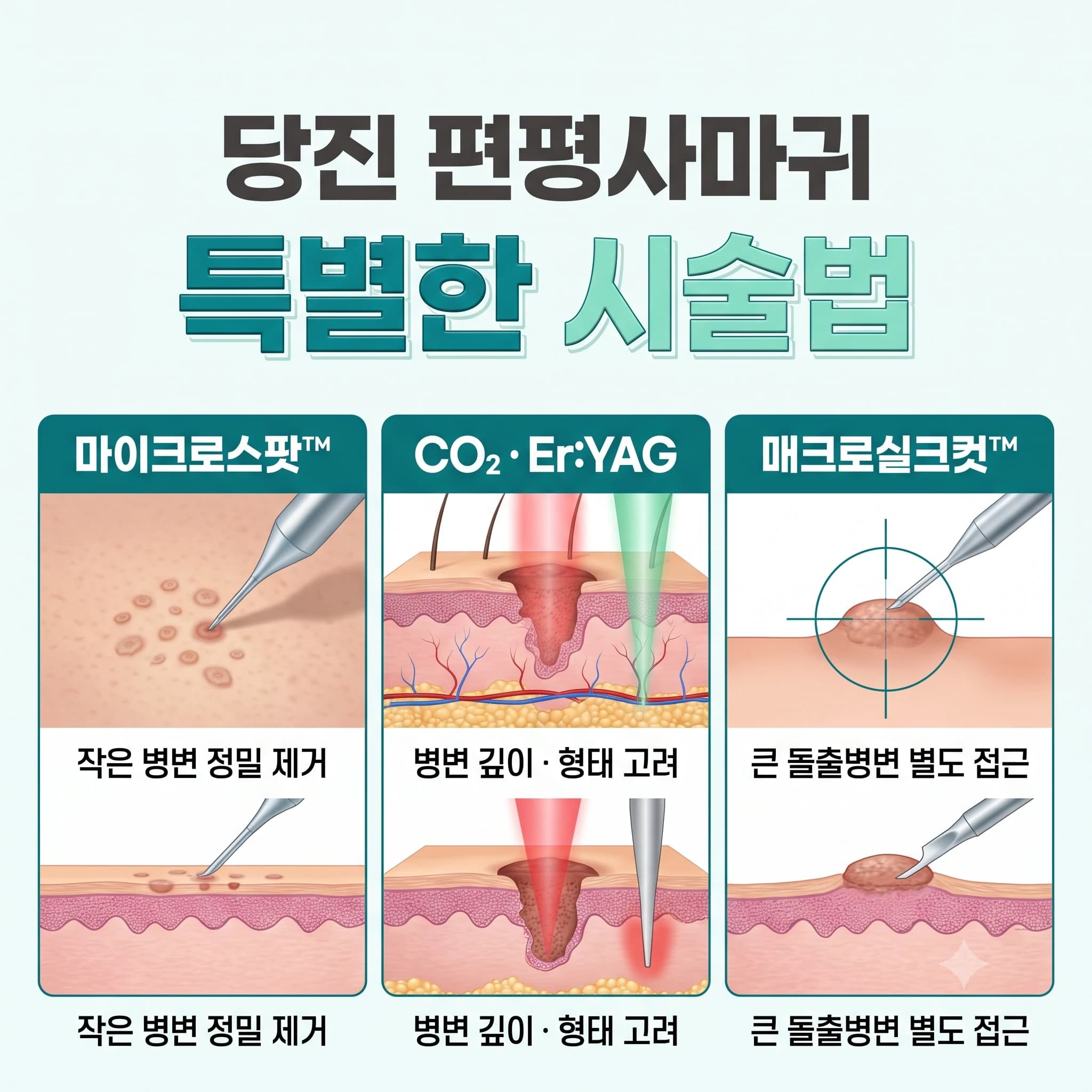 당진 편평사마귀 특별한 시술법
