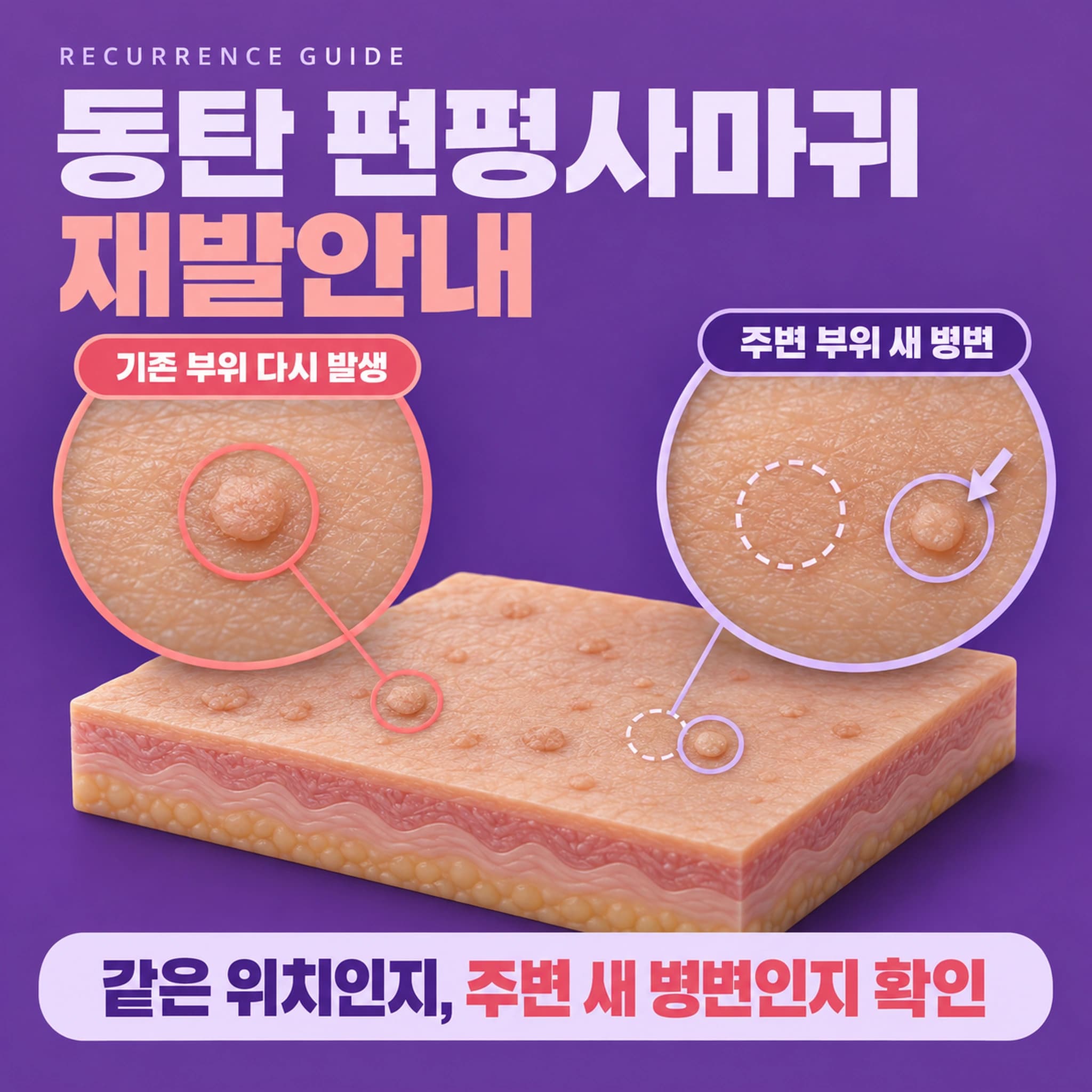 동탄 편평사마귀 재발안내