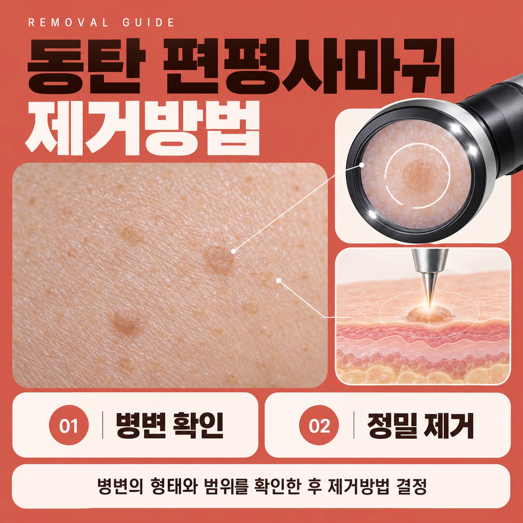 동탄 편평사마귀 제거방법
