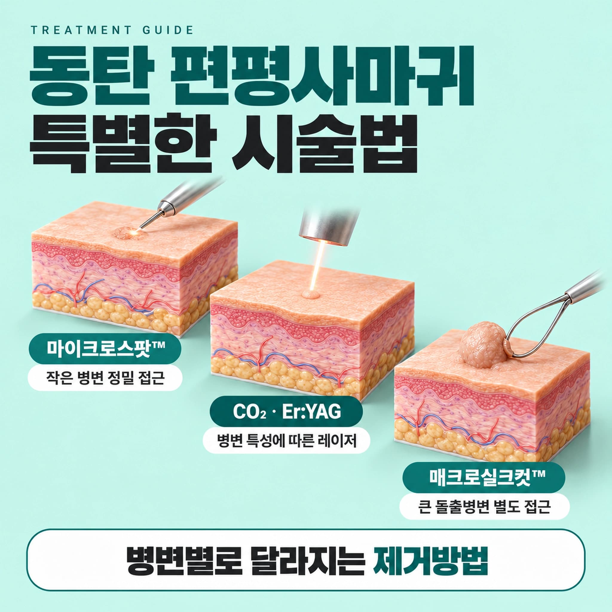 동탄 편평사마귀 특별한 시술법