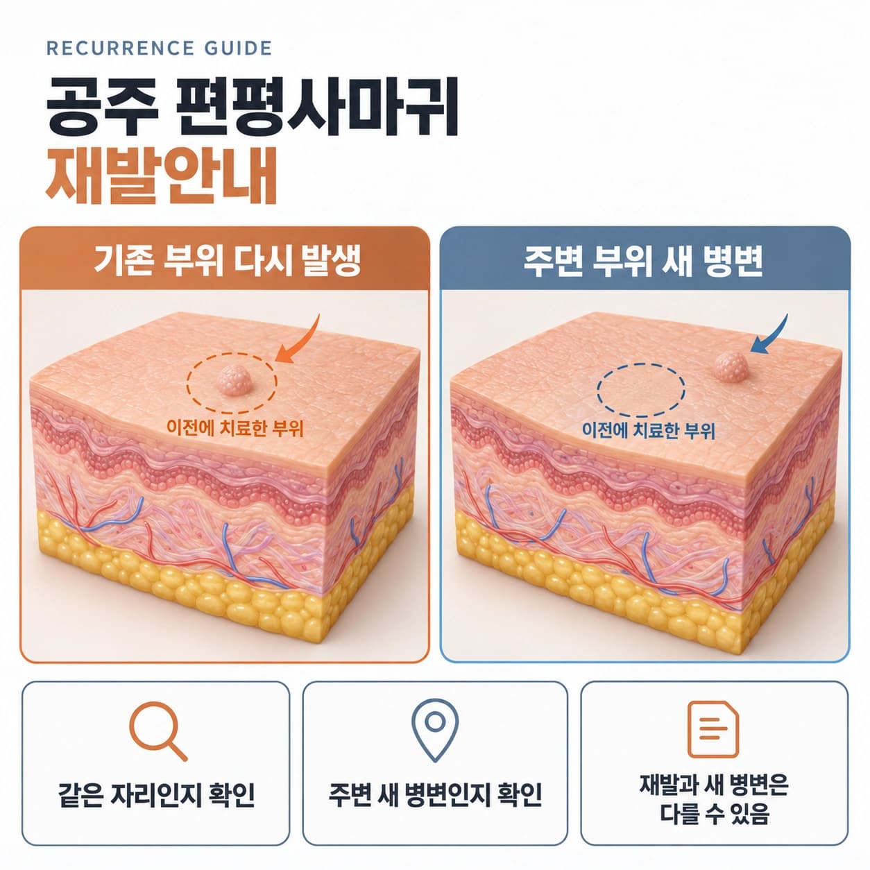 공주 편평사마귀 재발안내