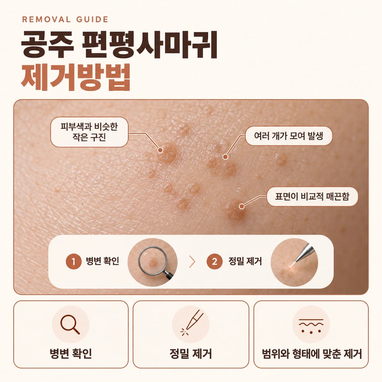 공주 편평사마귀 제거방법