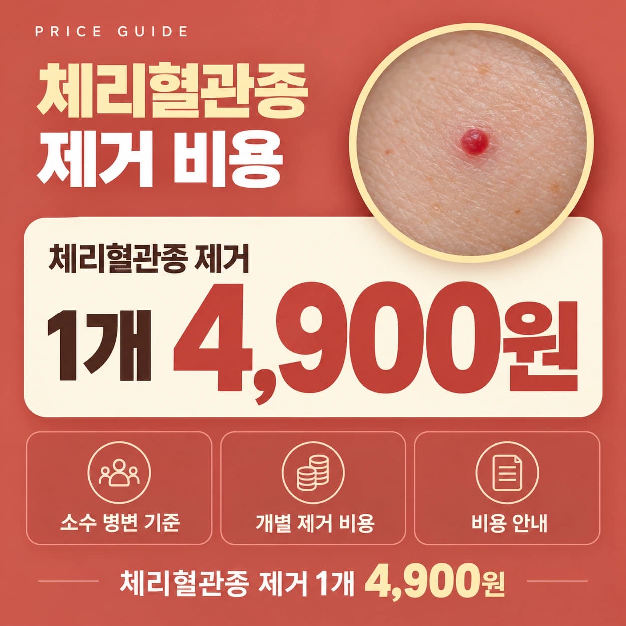 천안 체리혈관종 제거 비용