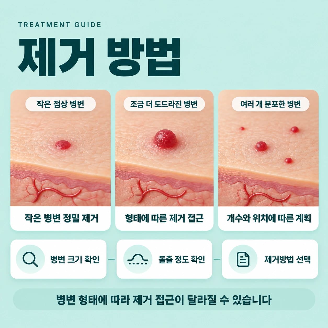 천안 체리혈관종 제거 제거방법
