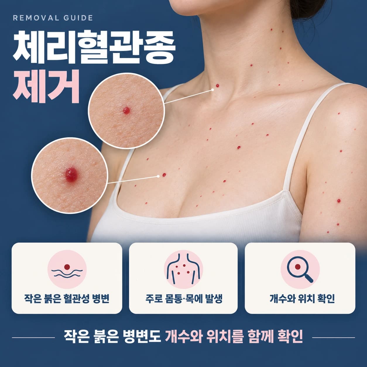 천안 체리혈관종 제거 무제한