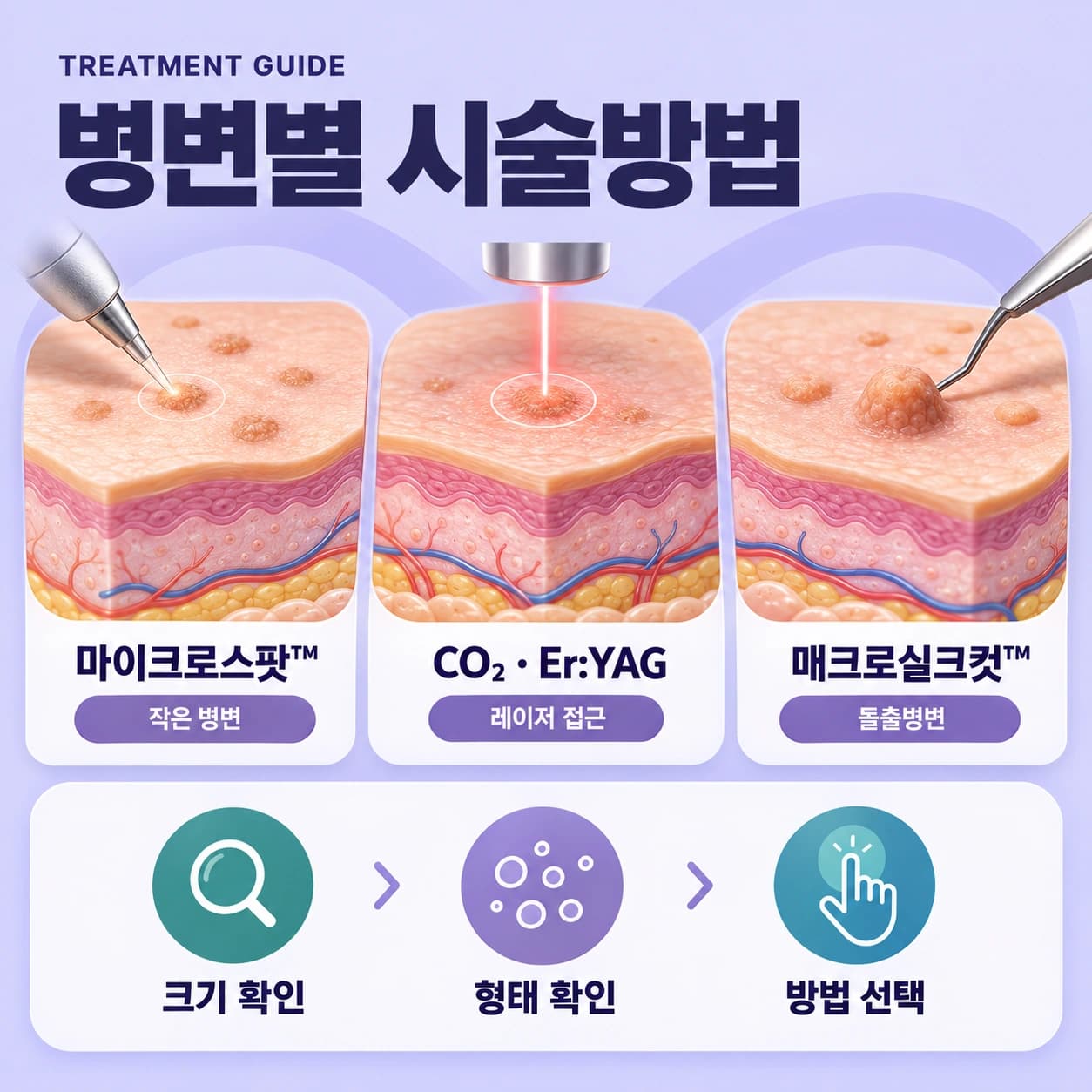 천안 편평사마귀 특별한 시술법