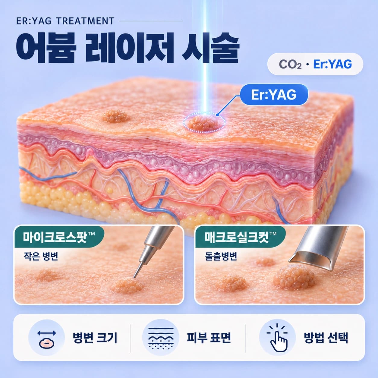 천안 편평사마귀 특별한 시술법