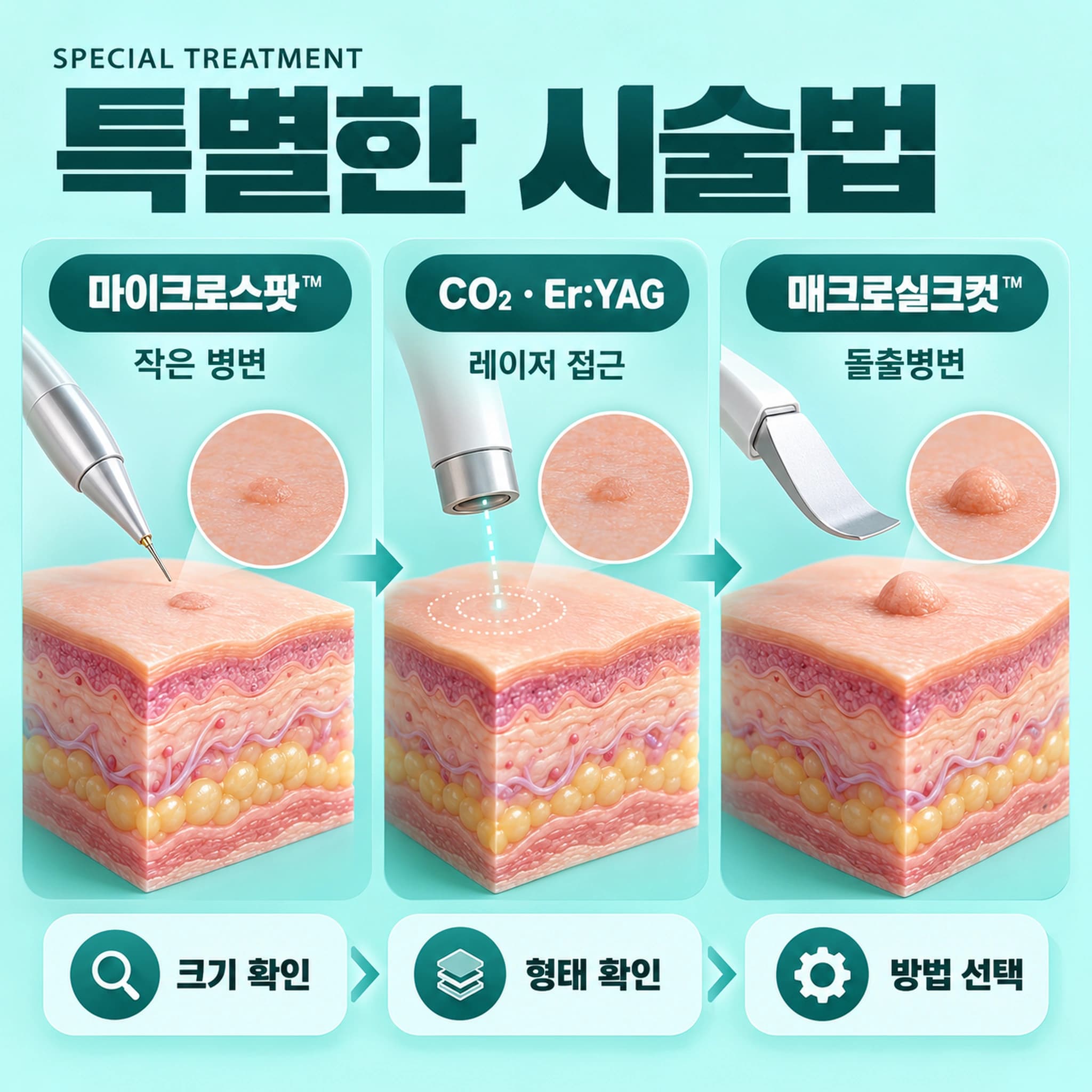 천안 편평사마귀 특별한 시술법