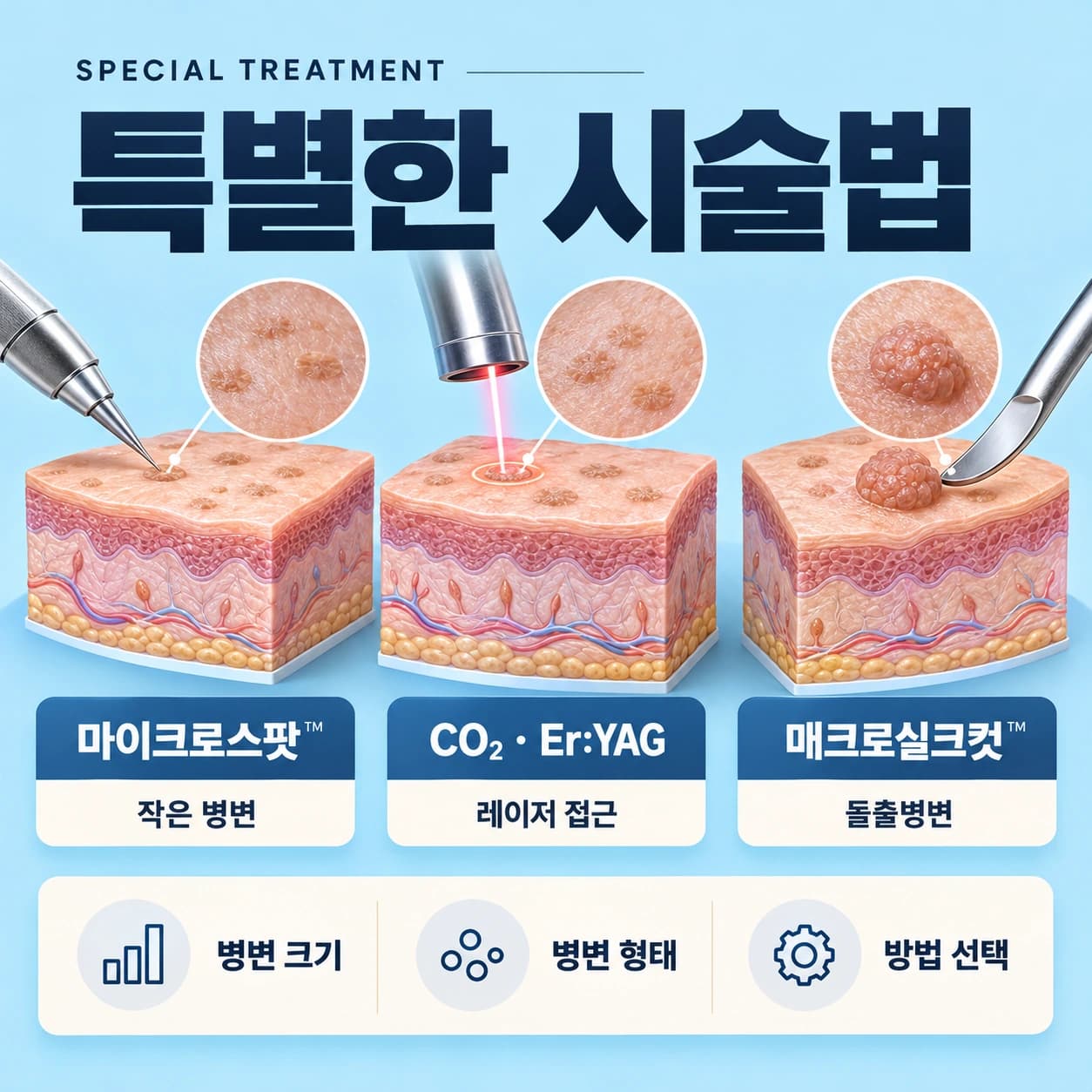 천안 편평사마귀 특별한 시술법