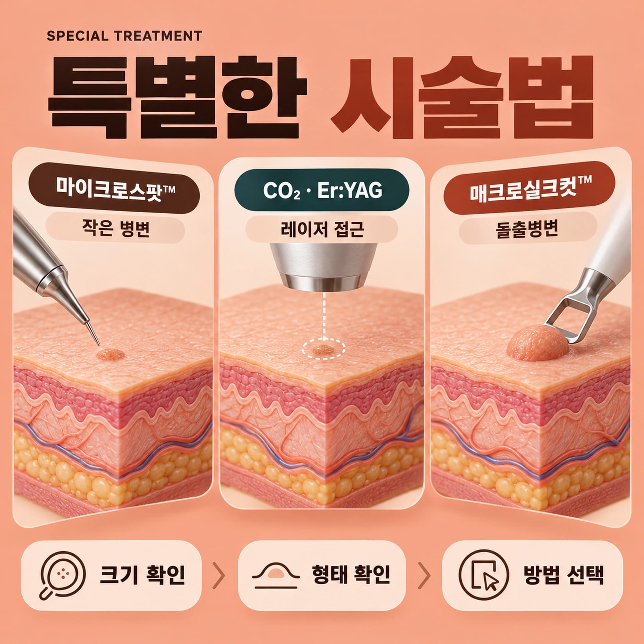 천안 편평사마귀 특별한 시술법