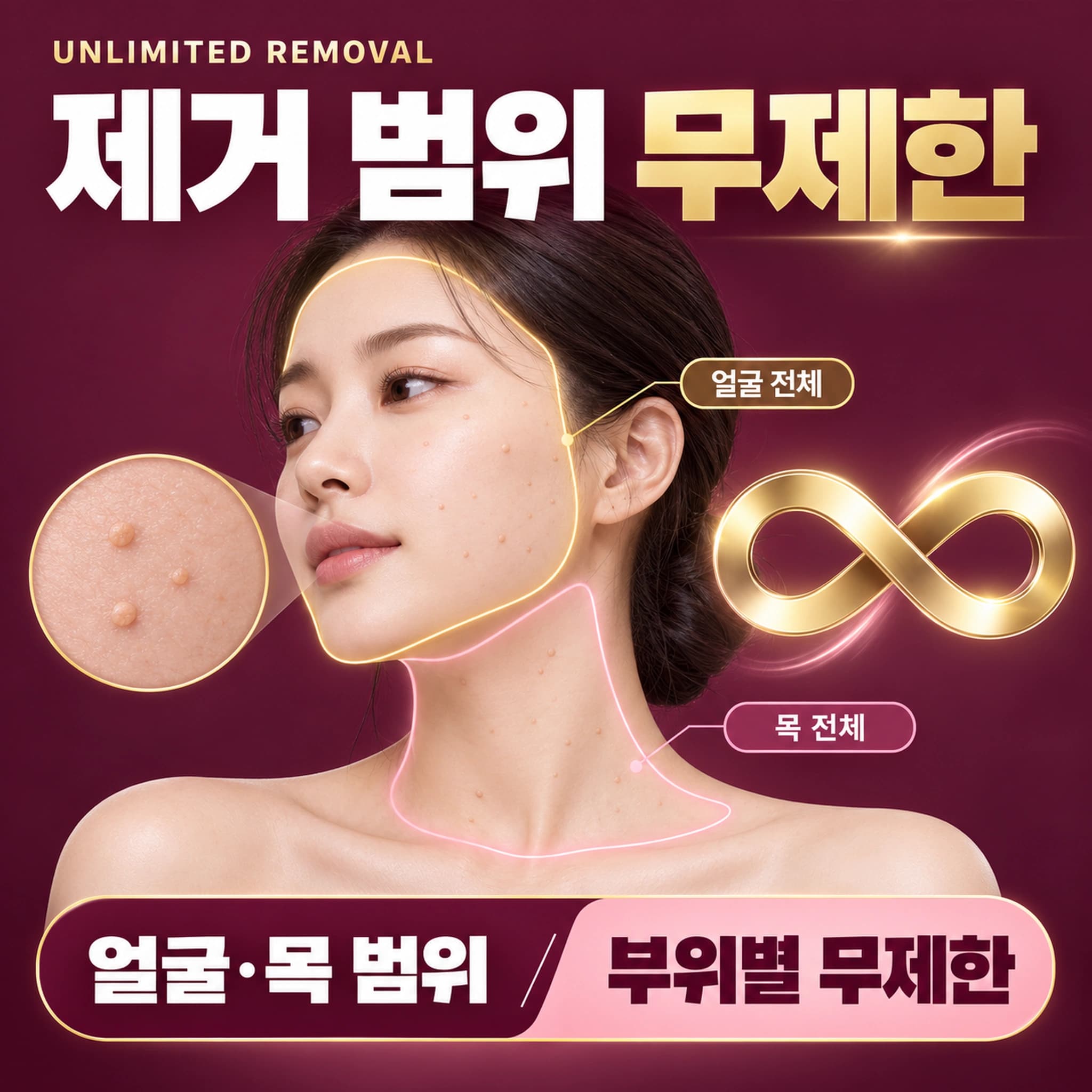 천안 편평사마귀 무제한