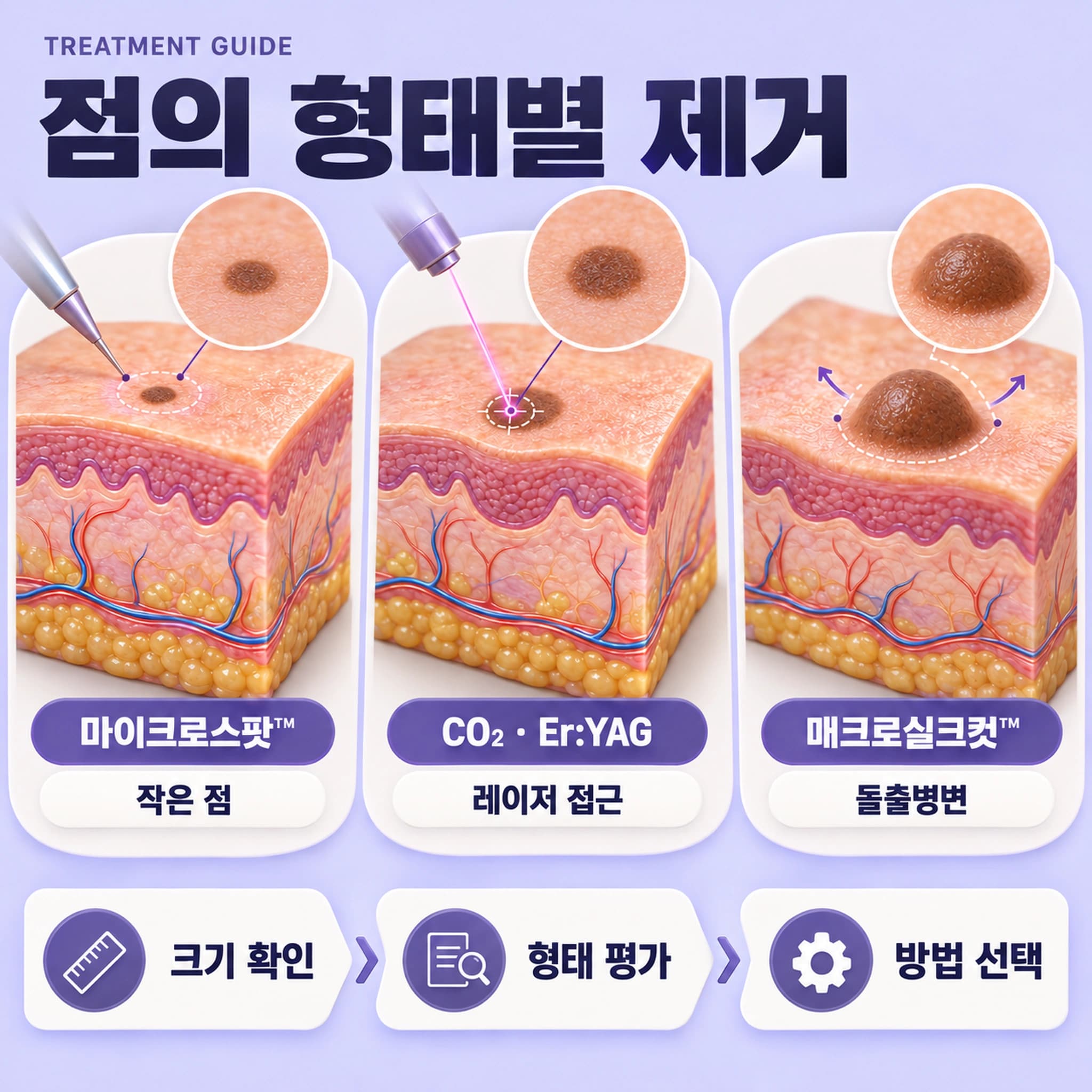 천안 점제거 제거방법