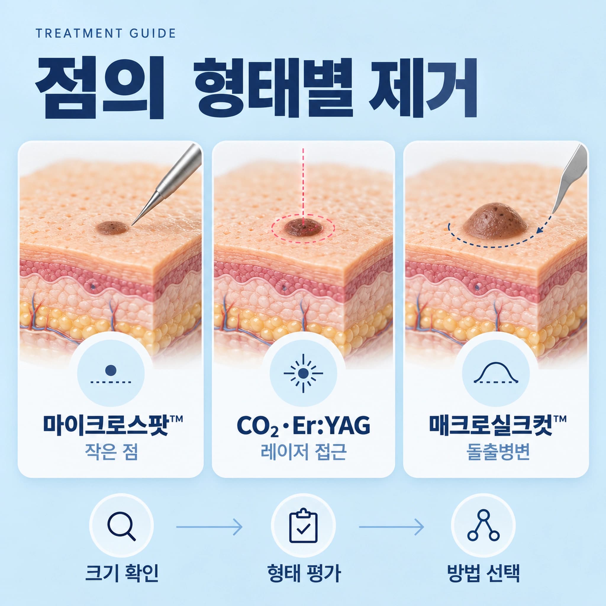 천안 점빼기 추천 제거방법