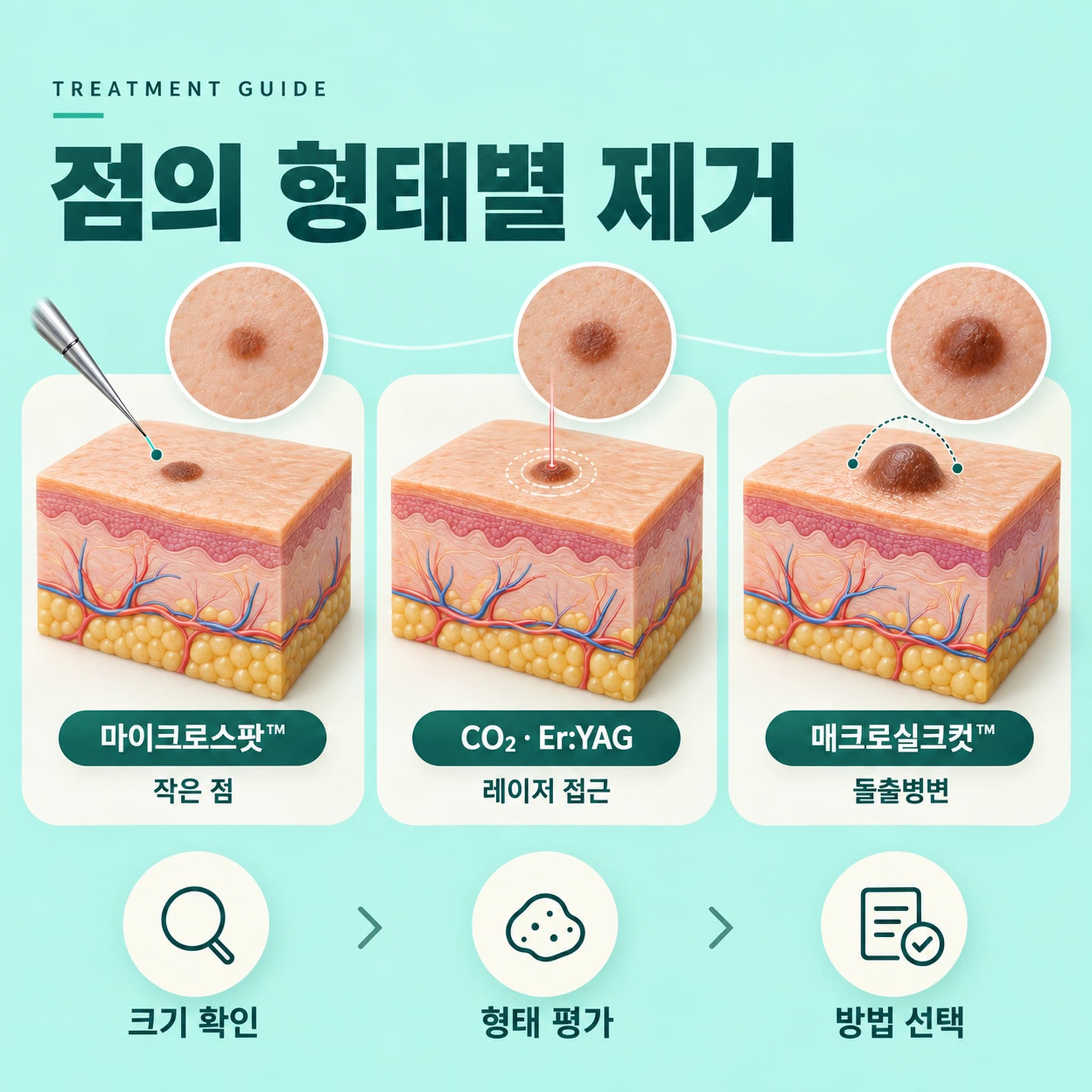 천안 점빼기 무제한 제거방법