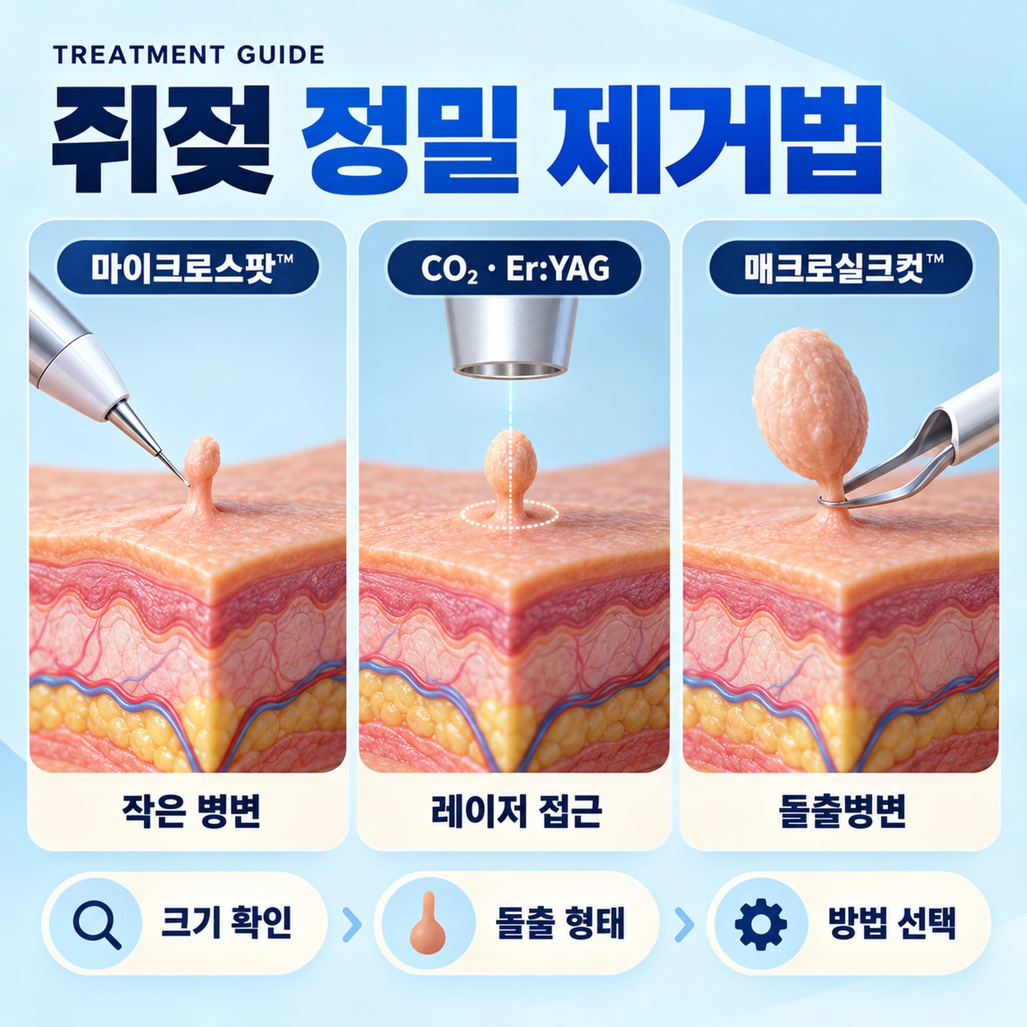 천안 쥐젖 제거 제거방법