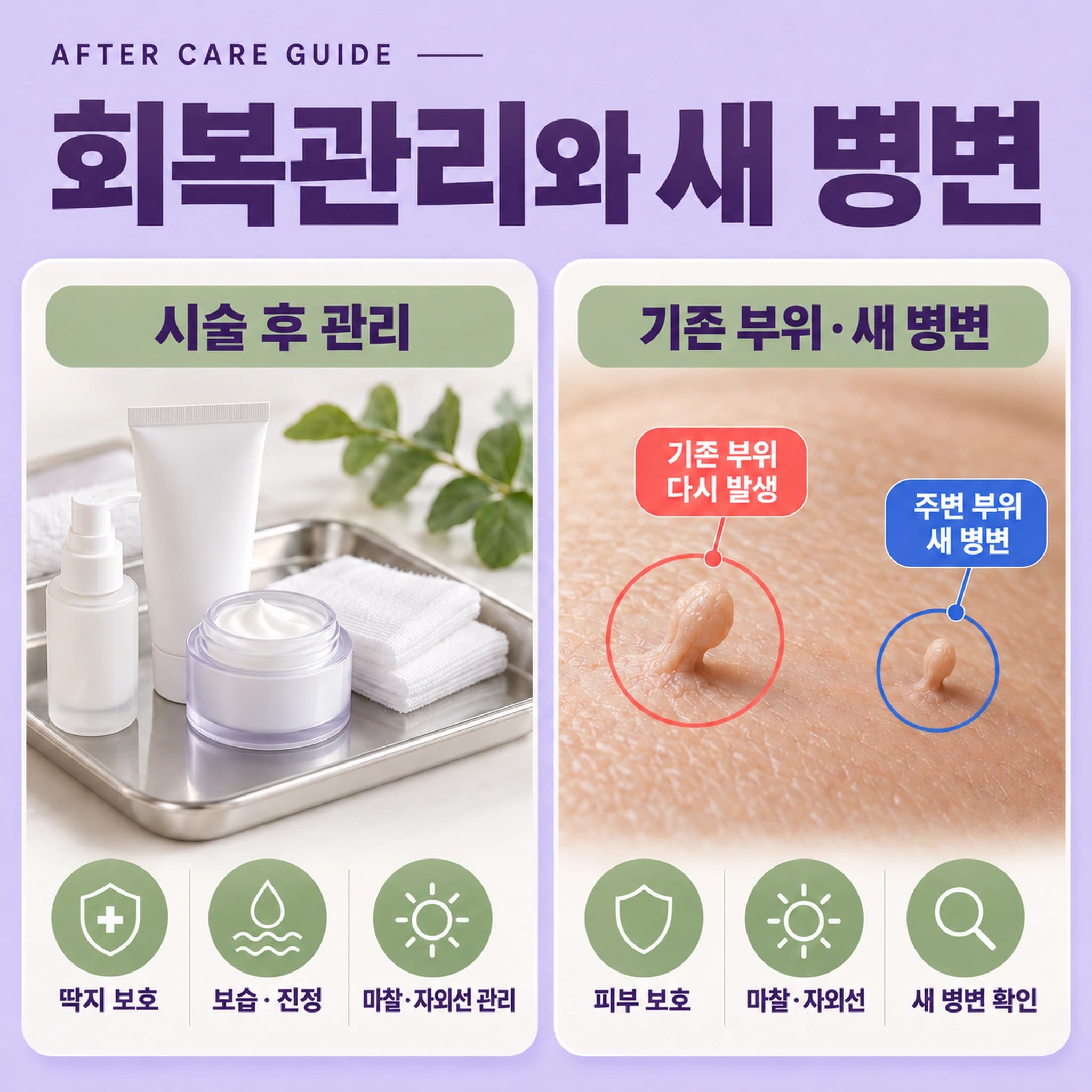 천안 쥐젖 제거 무제한 시술 후 관리