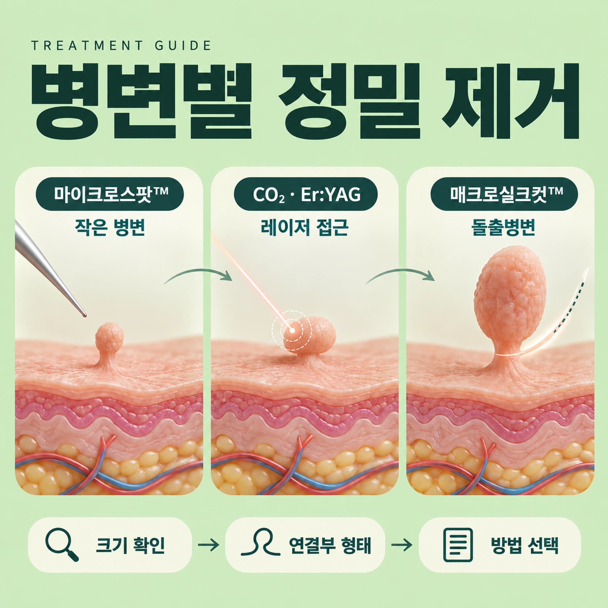 천안 쥐젖 제거 무제한 제거방법