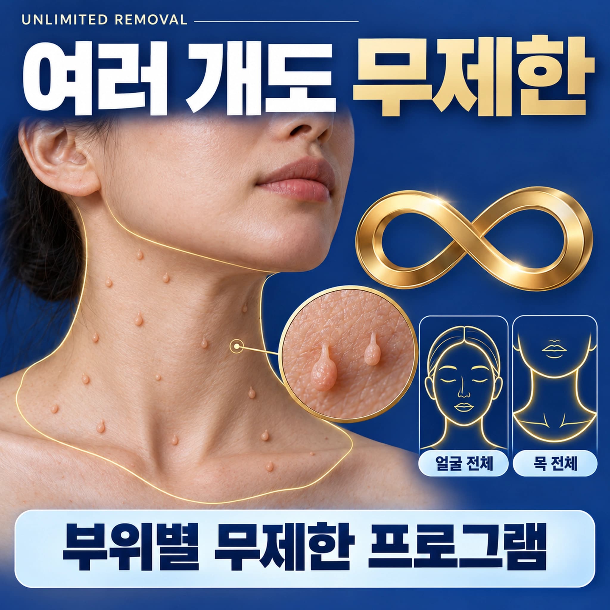 천안 쥐젖 제거 무제한 무제한