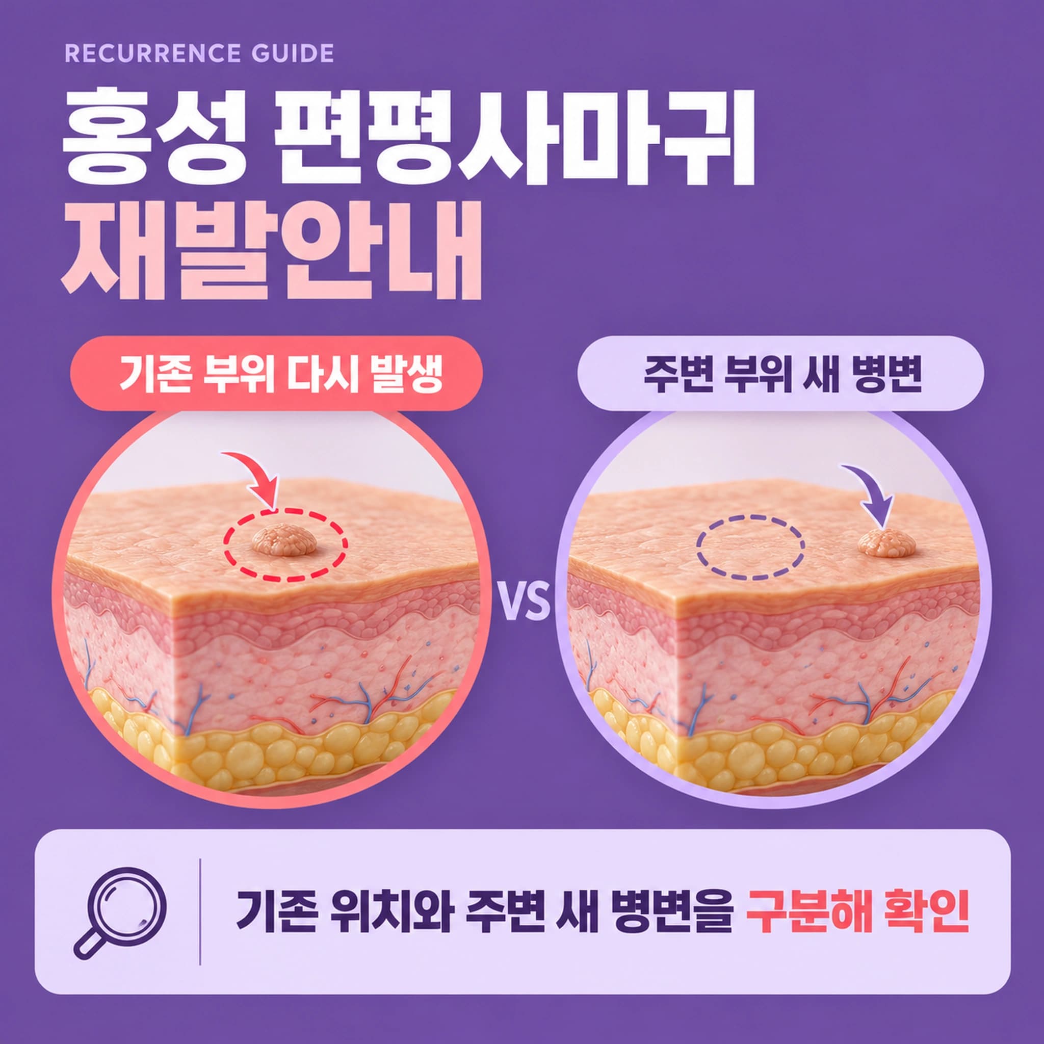 홍성 편평사마귀 재발안내