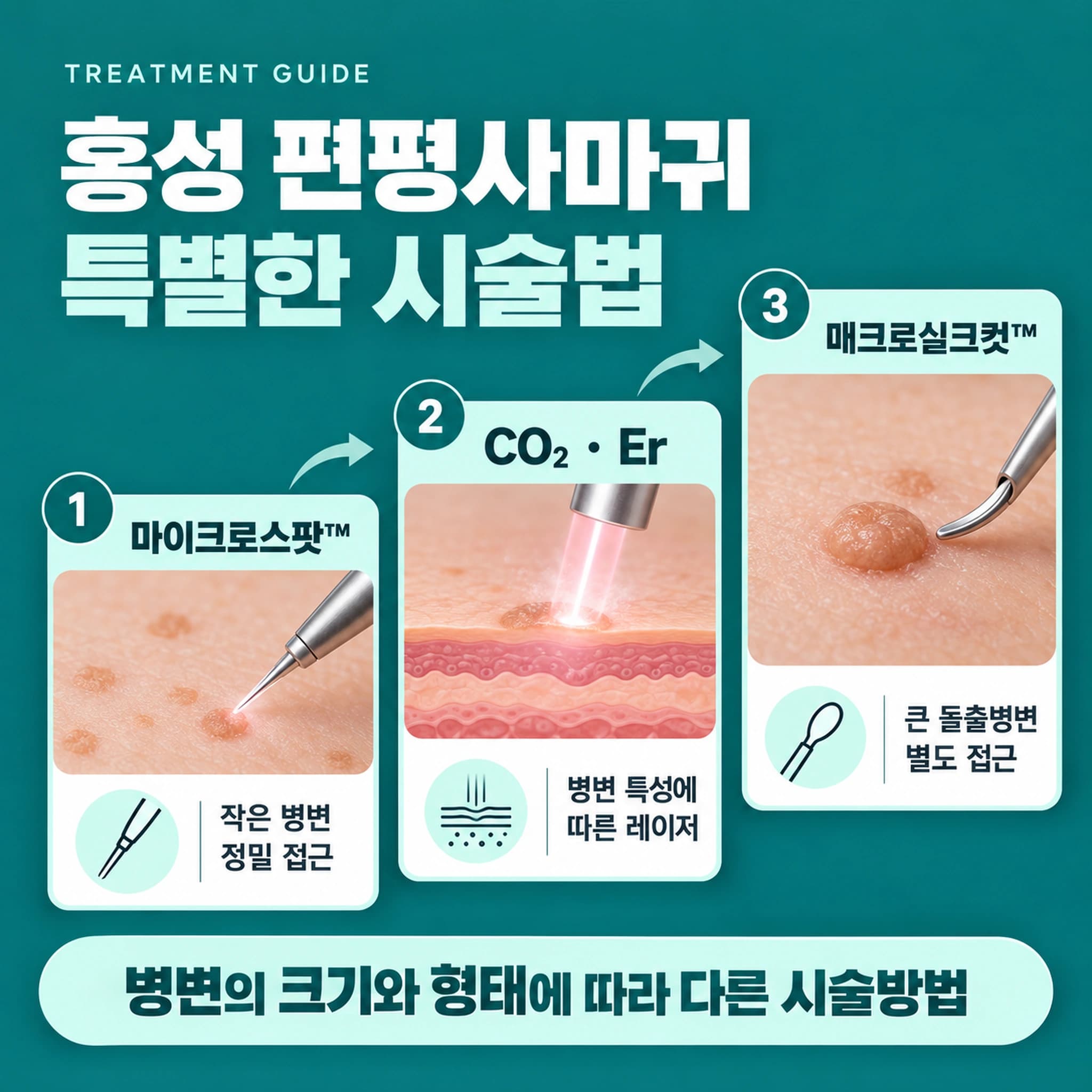 홍성 편평사마귀 특별한 시술법