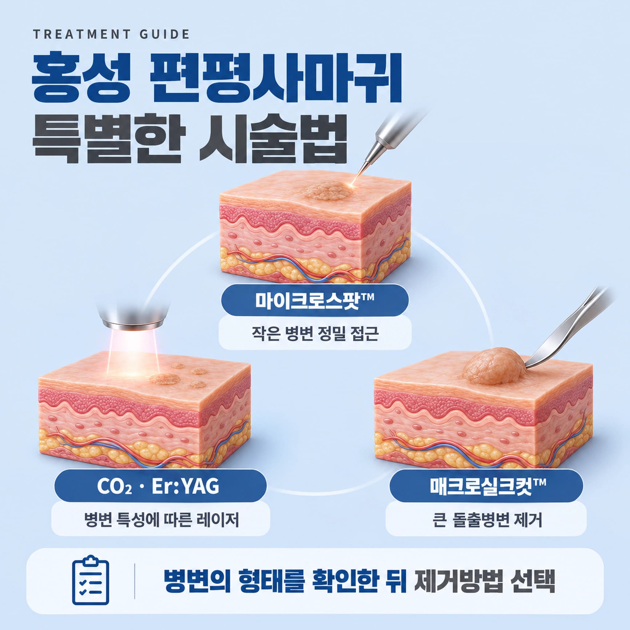 홍성 편평사마귀 특별한 시술법
