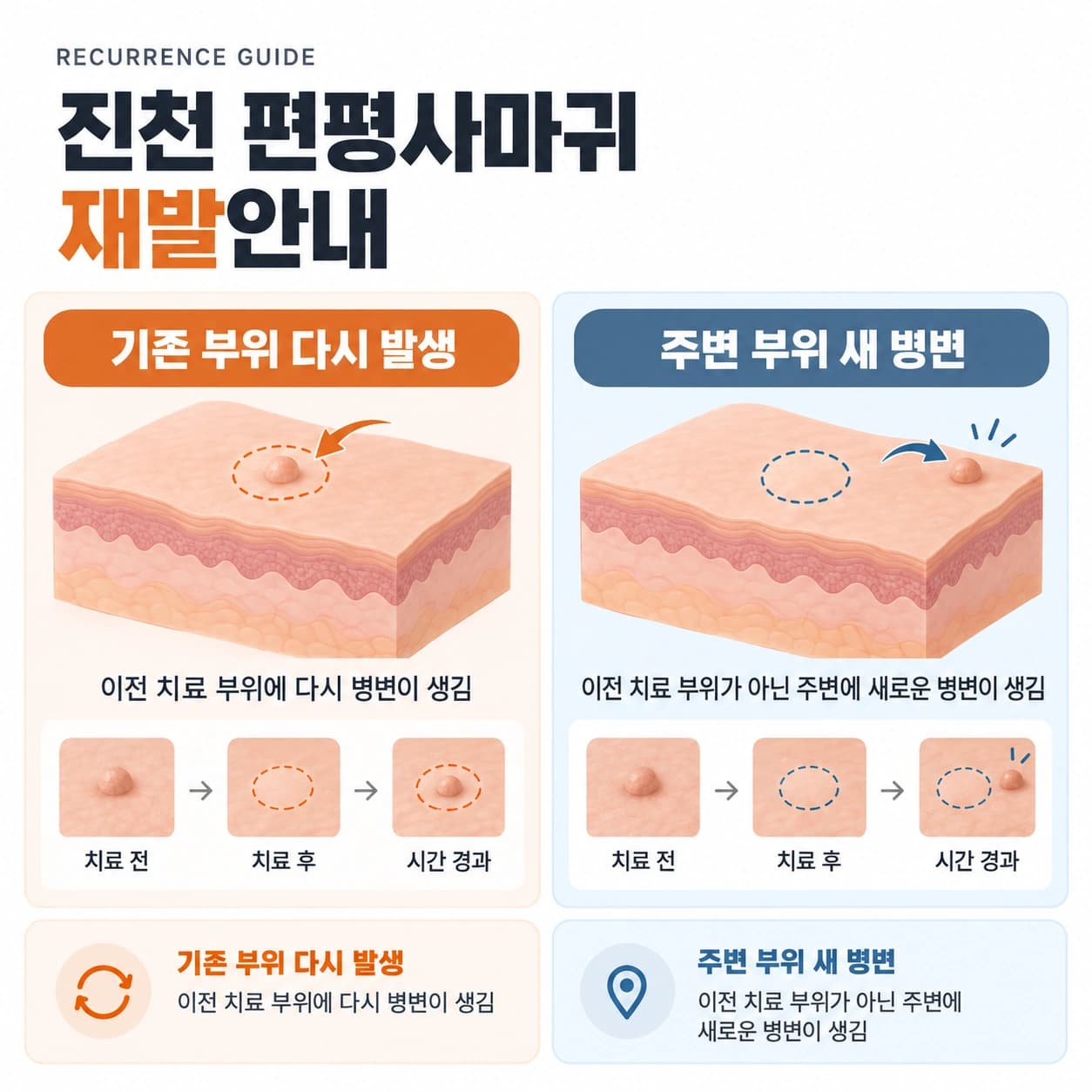 진천 편평사마귀 재발안내