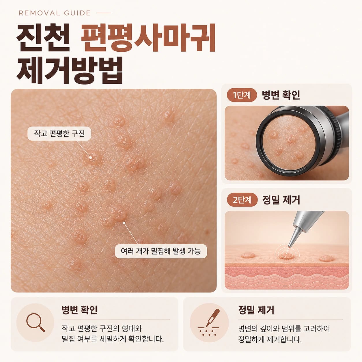 진천 편평사마귀 제거방법