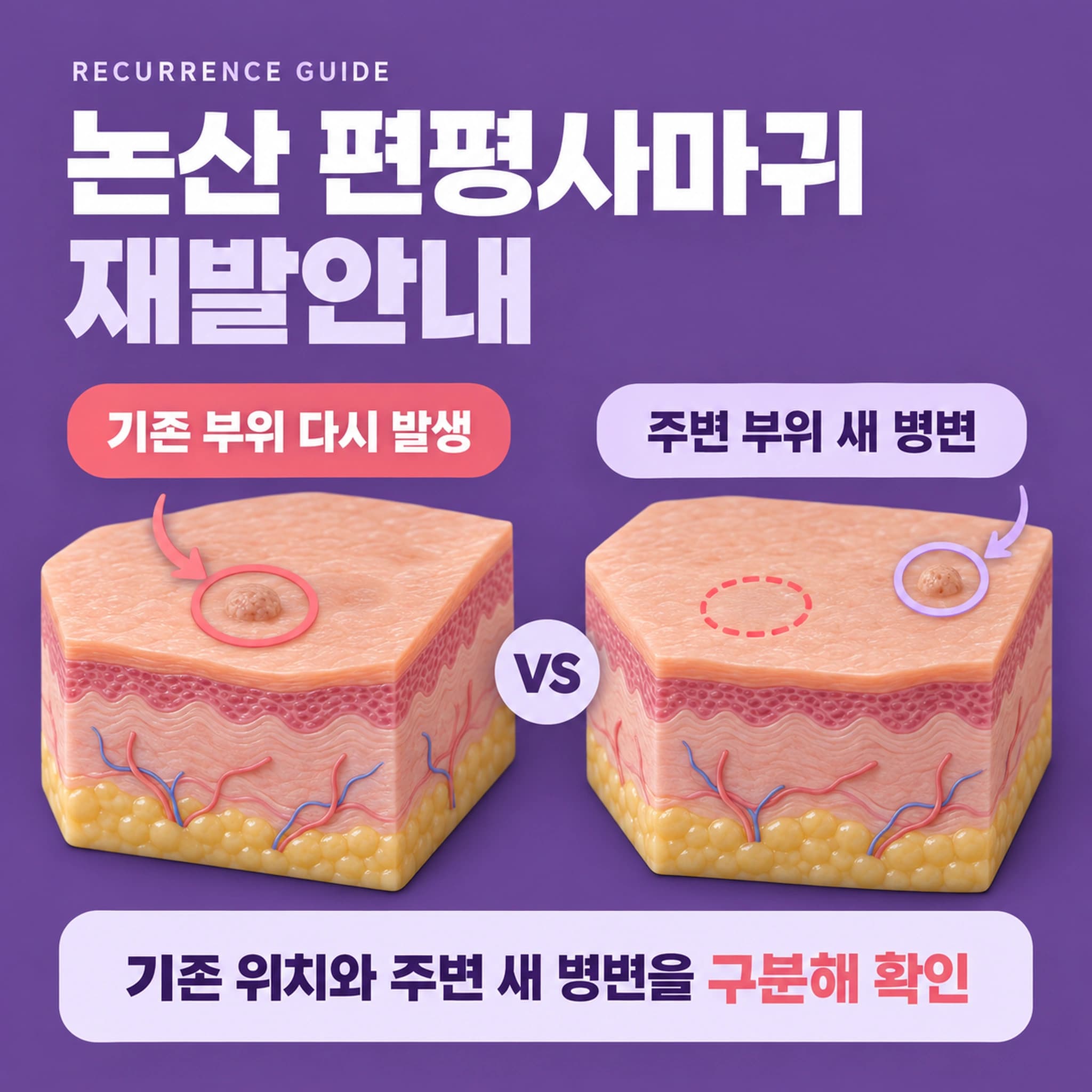논산 편평사마귀 재발안내