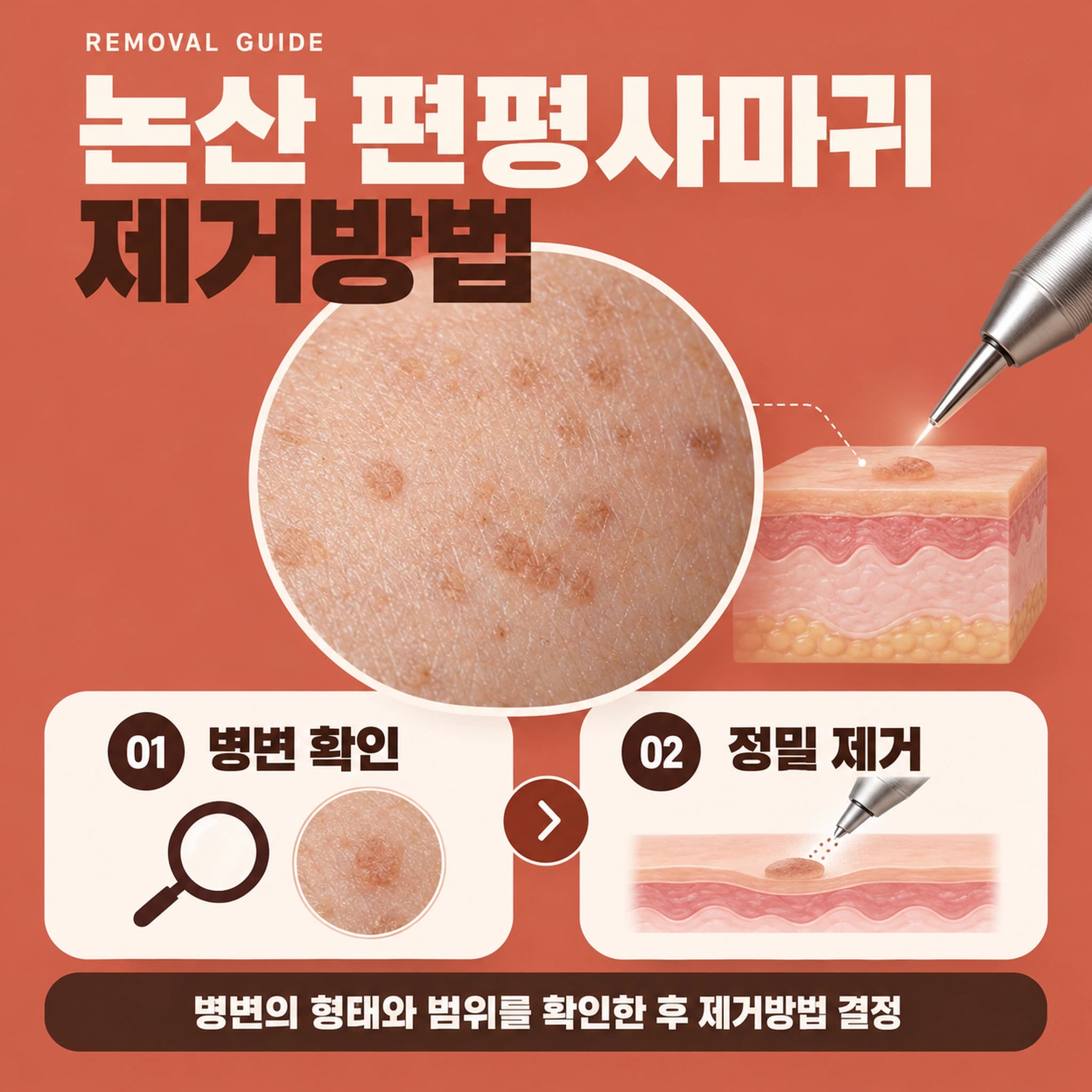 논산 편평사마귀 제거방법