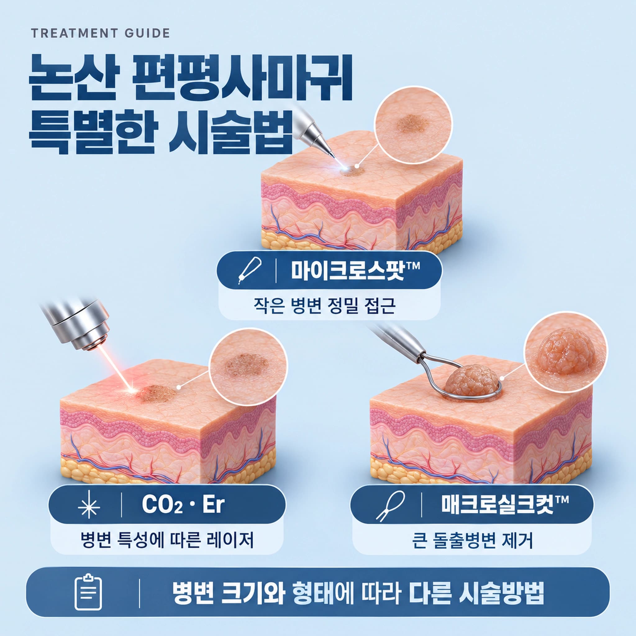 논산 편평사마귀 특별한 시술법