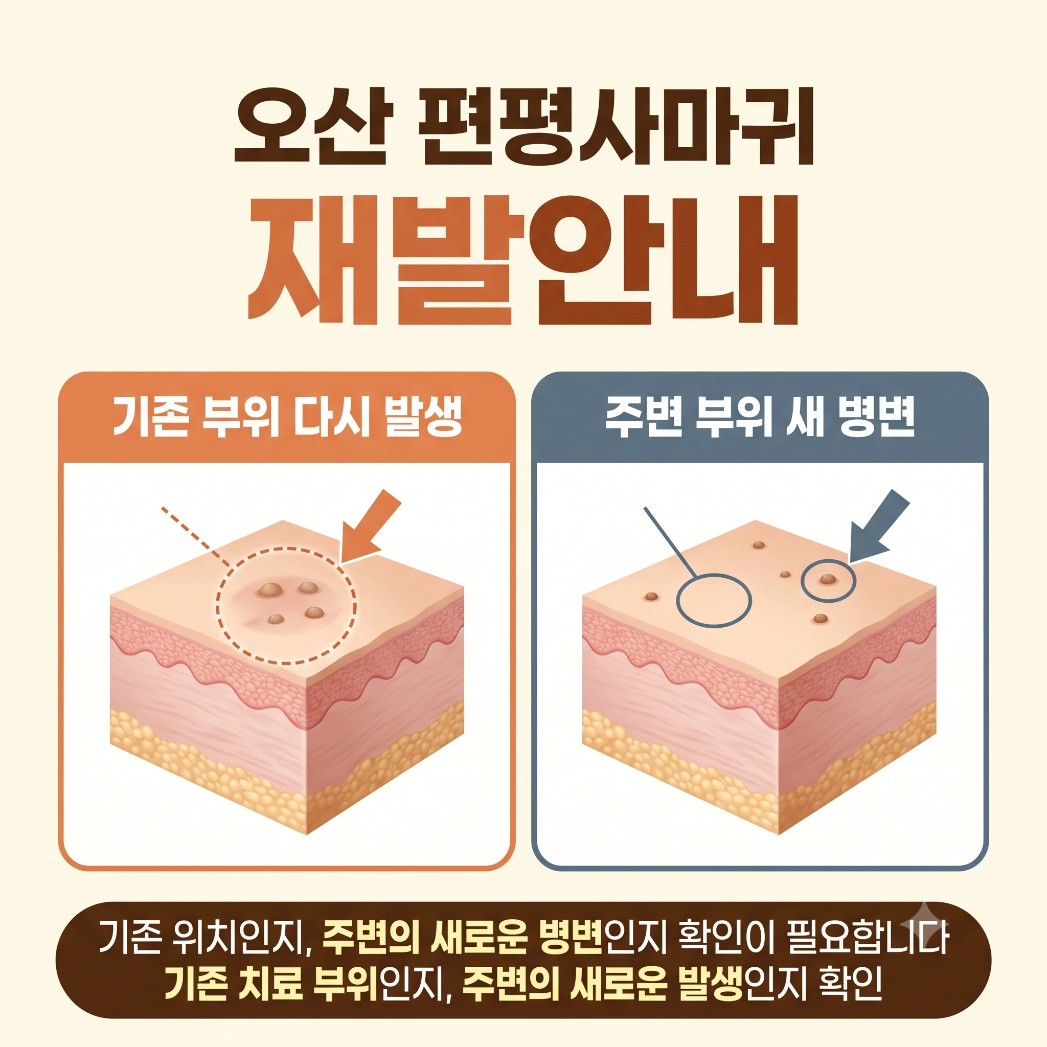 오산 편평사마귀 재발안내