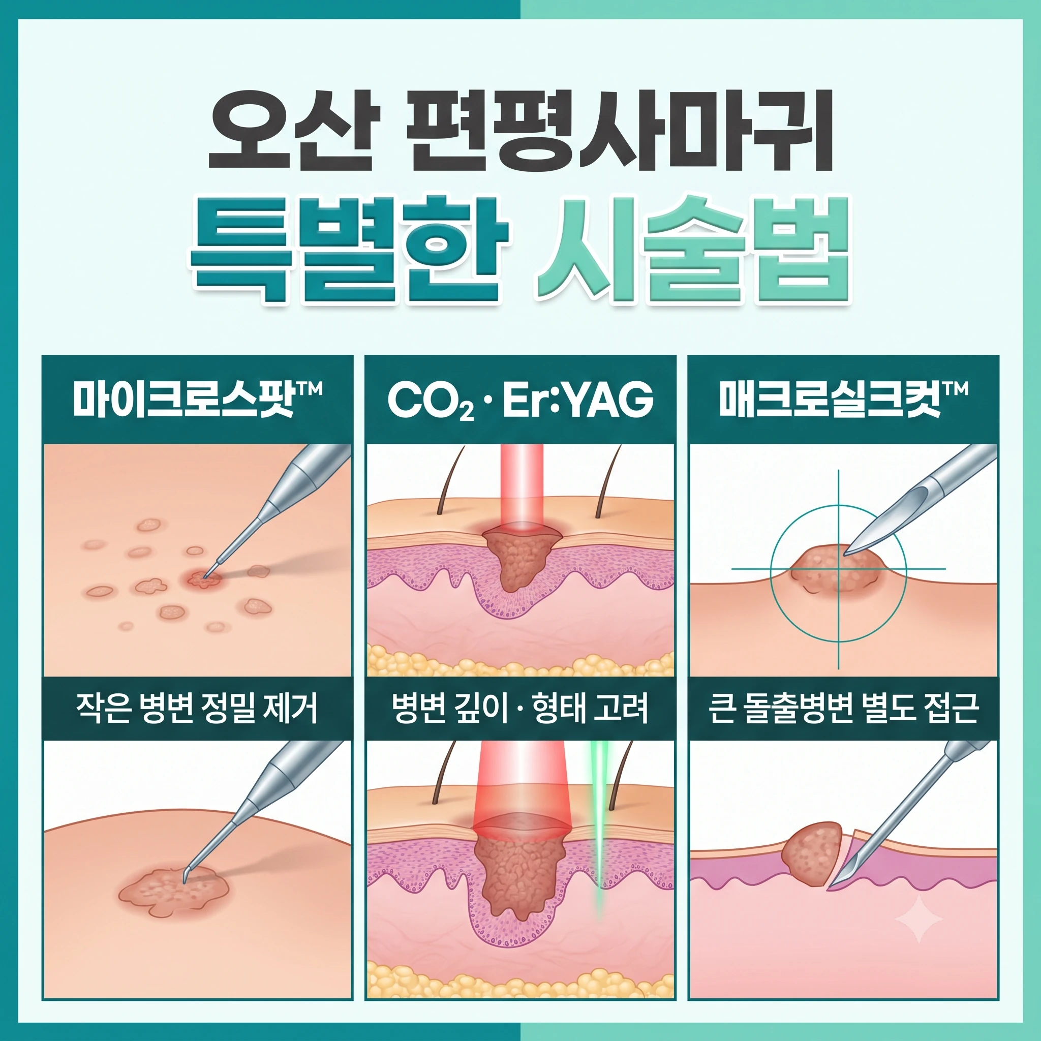 오산 편평사마귀 특별한 시술법