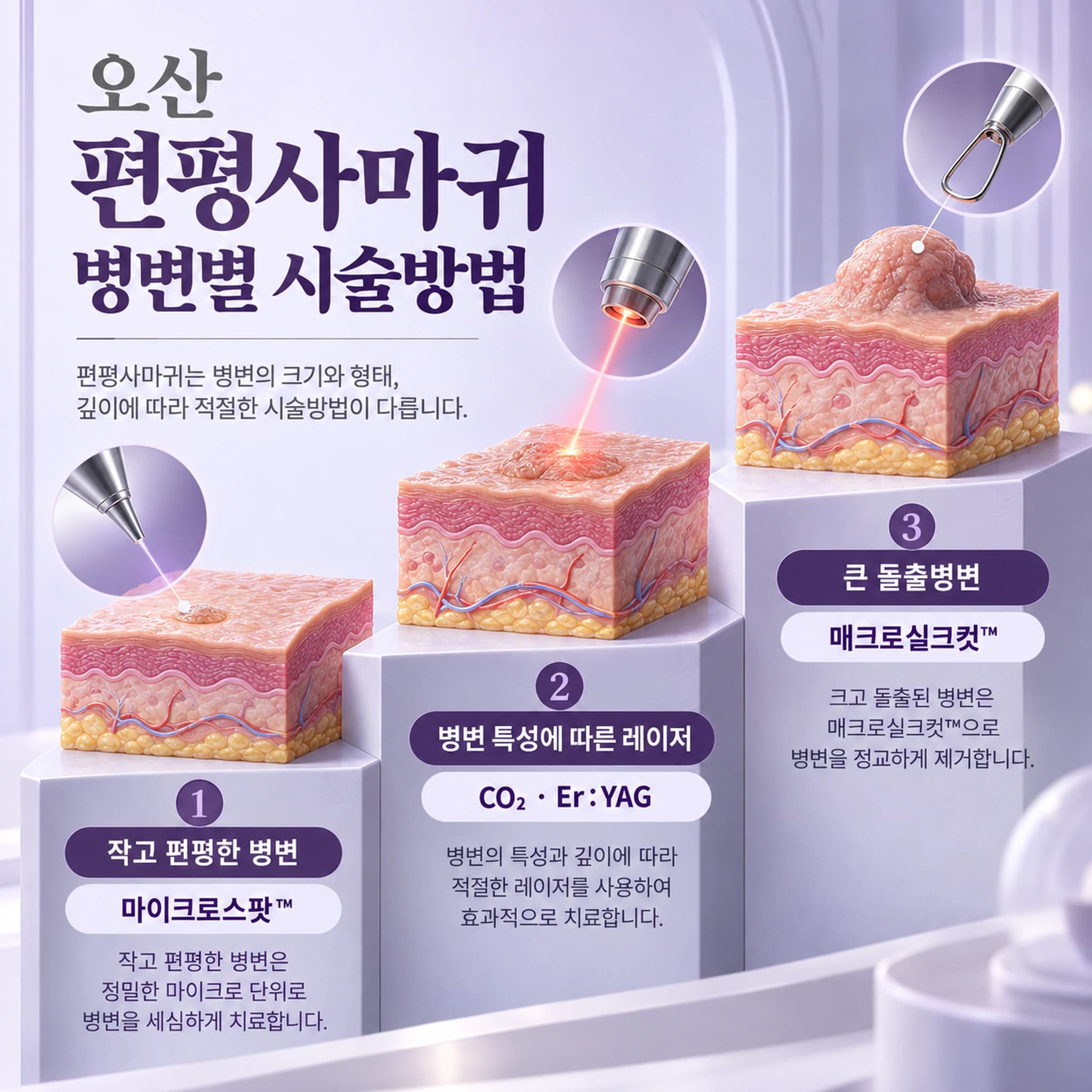 오산 편평사마귀 특별한 시술법