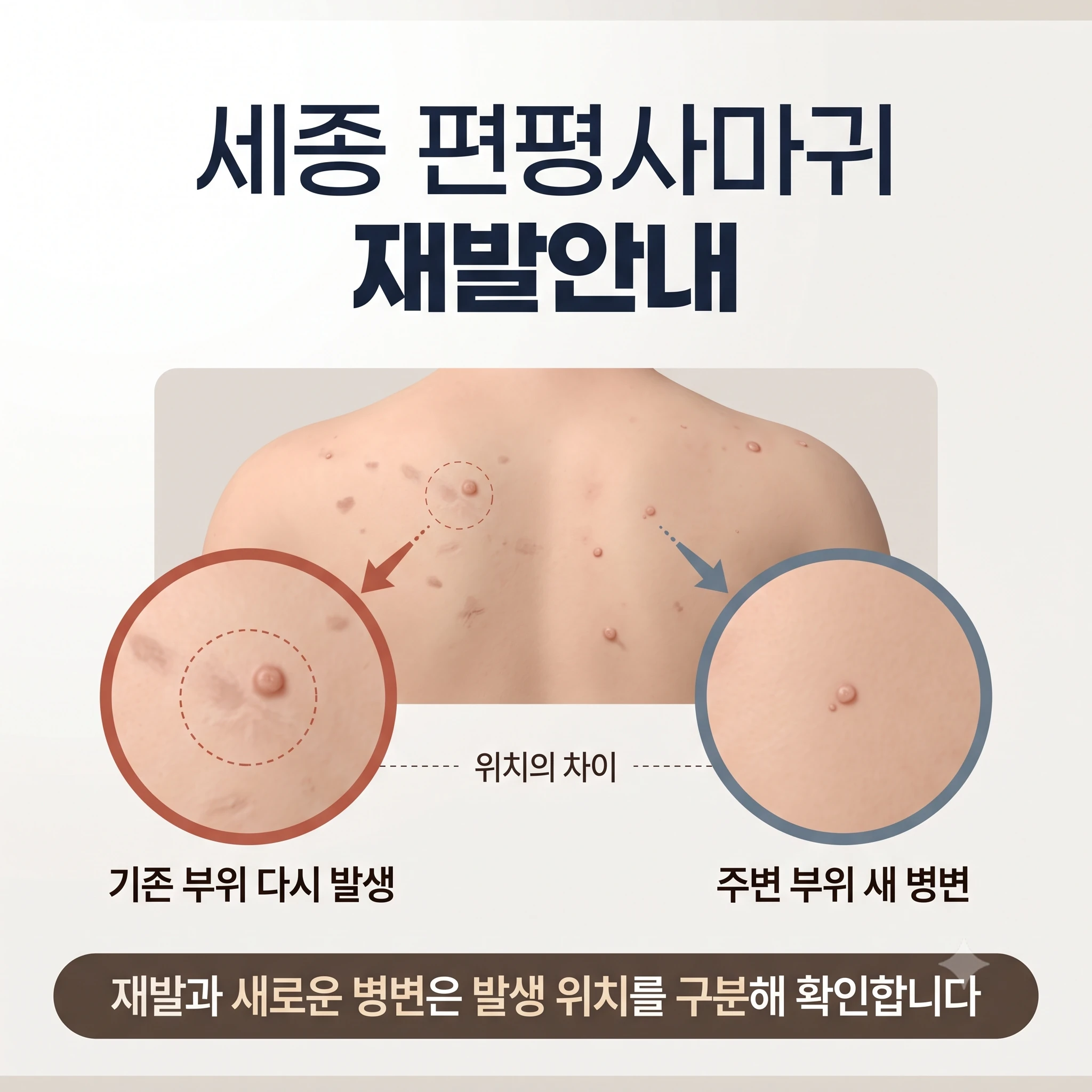 세종 편평사마귀 재발안내