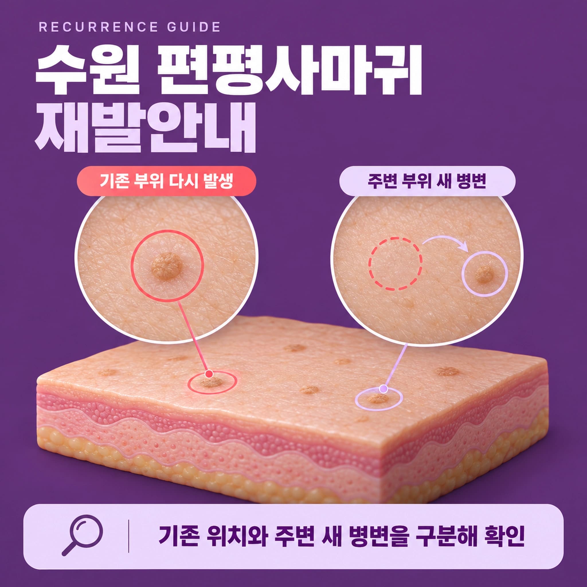 수원 편평사마귀 재발안내